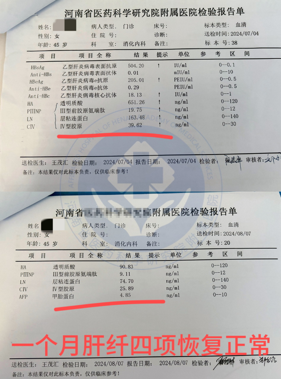 一个月前感觉乏力,厌食来院检查,肝纤四项均不正常,在我的的建议下