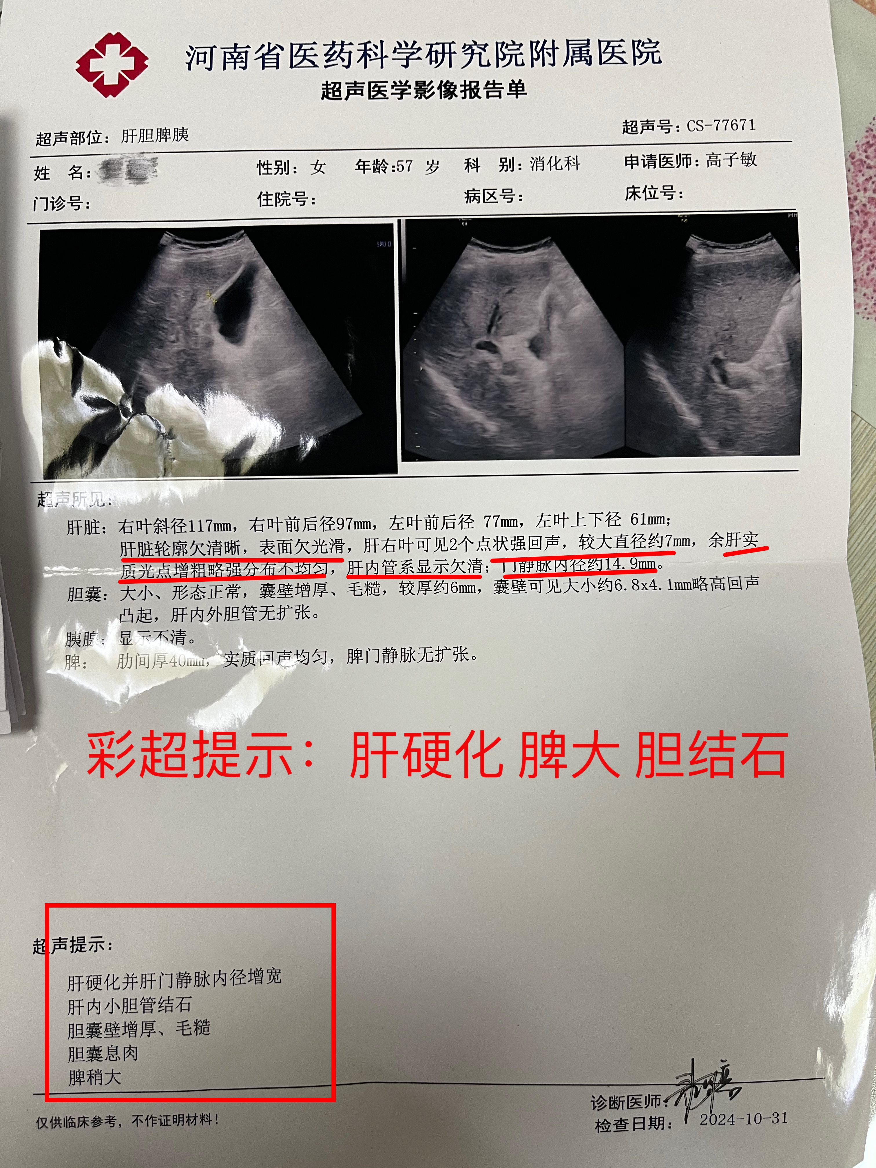 给大家分享一个典型的酒精性肝硬化案例,此患者没有乙肝等病毒性肝炎