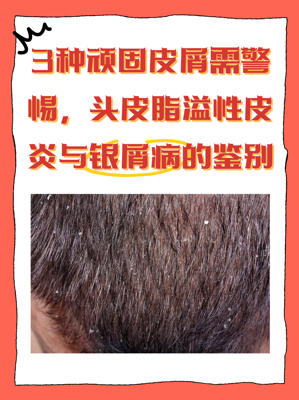 头皮屑为什么多