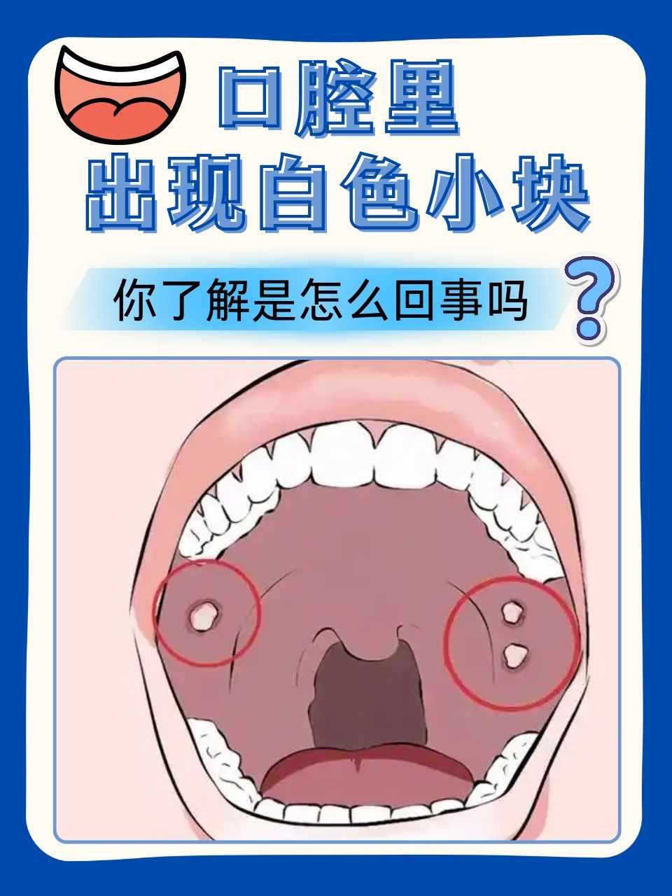 口腔里出现白色小块,你了解是怎么回事吗?