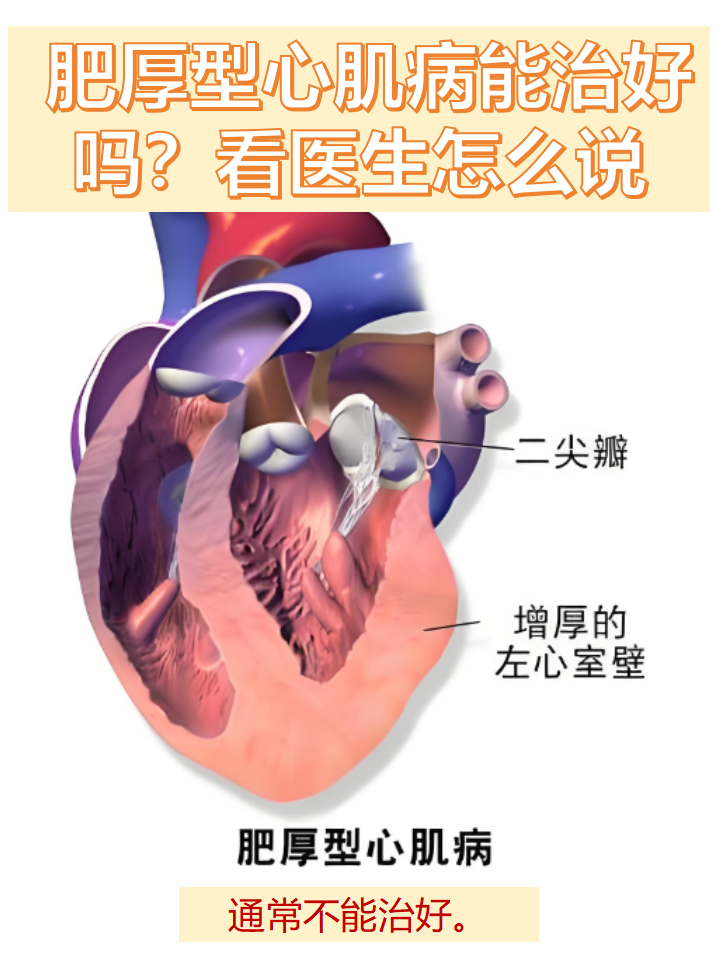 看医生怎么说  肥厚型心肌病是以心肌肥大,左心室流出通道受阻为典型