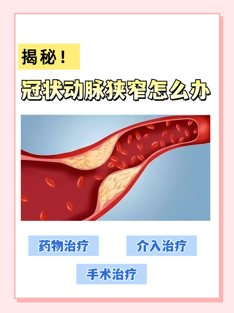 冠状动脉球囊扩张图片