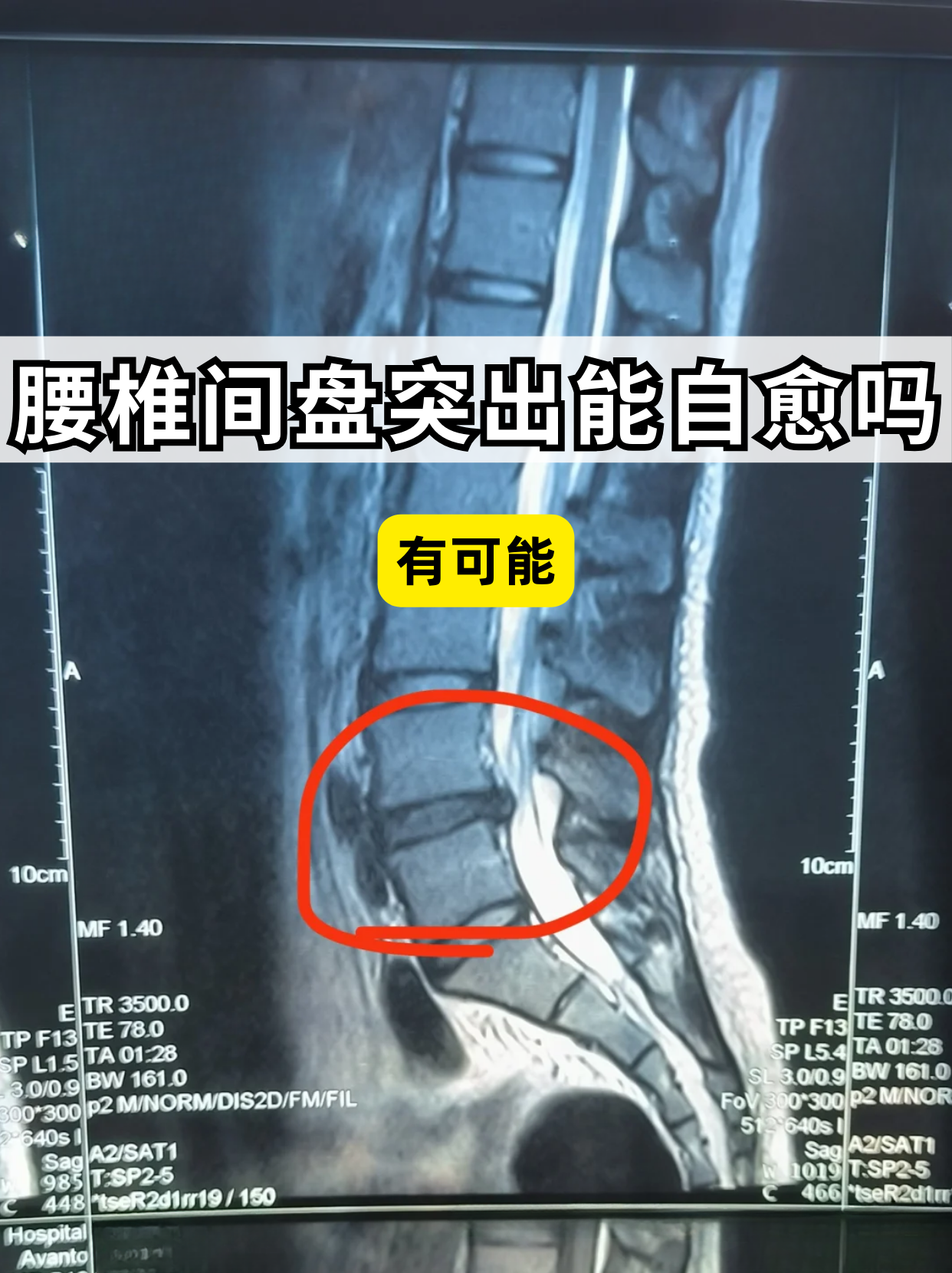 腰椎间盘突出是一种常见的脊柱疾病,主要是由于腰椎间盘各部分发刹换