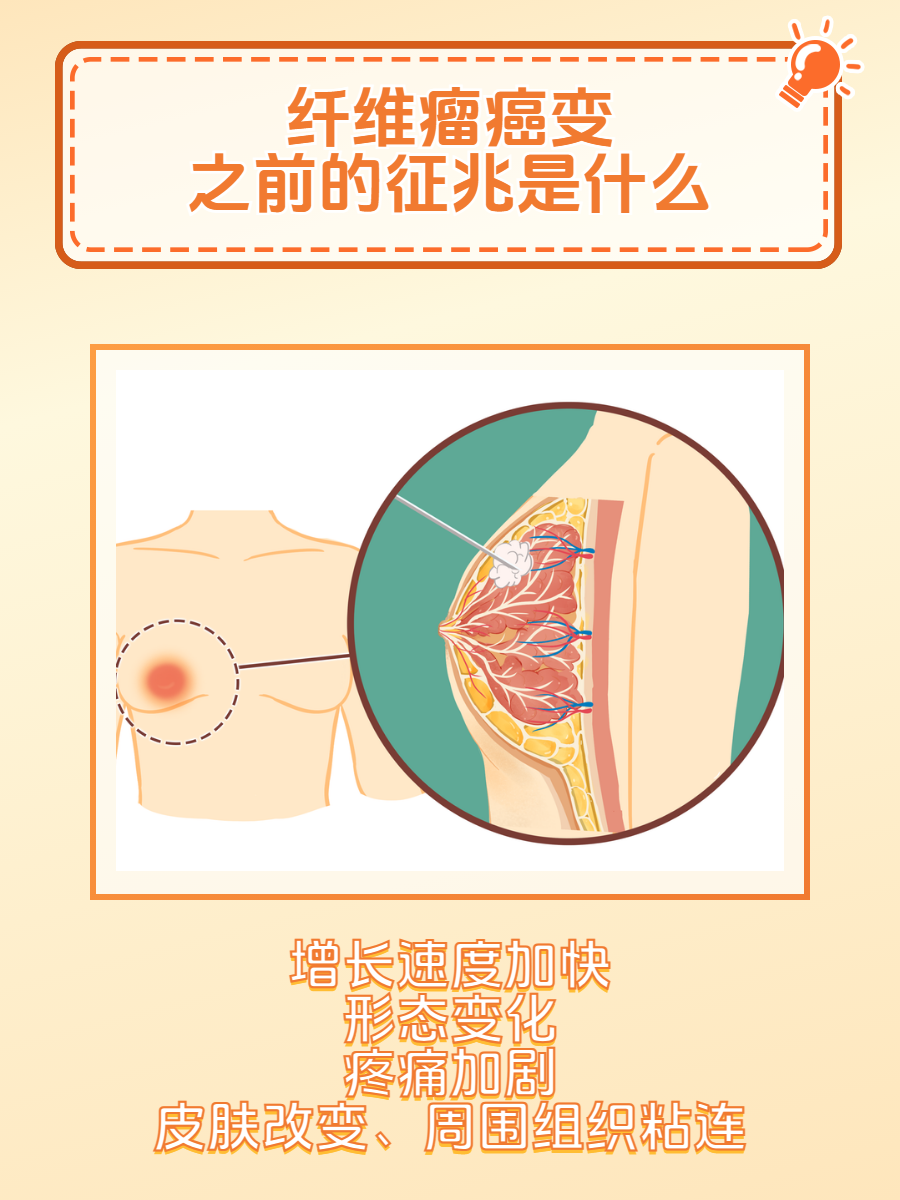 纤维瘤癌变之前的征兆是什么?