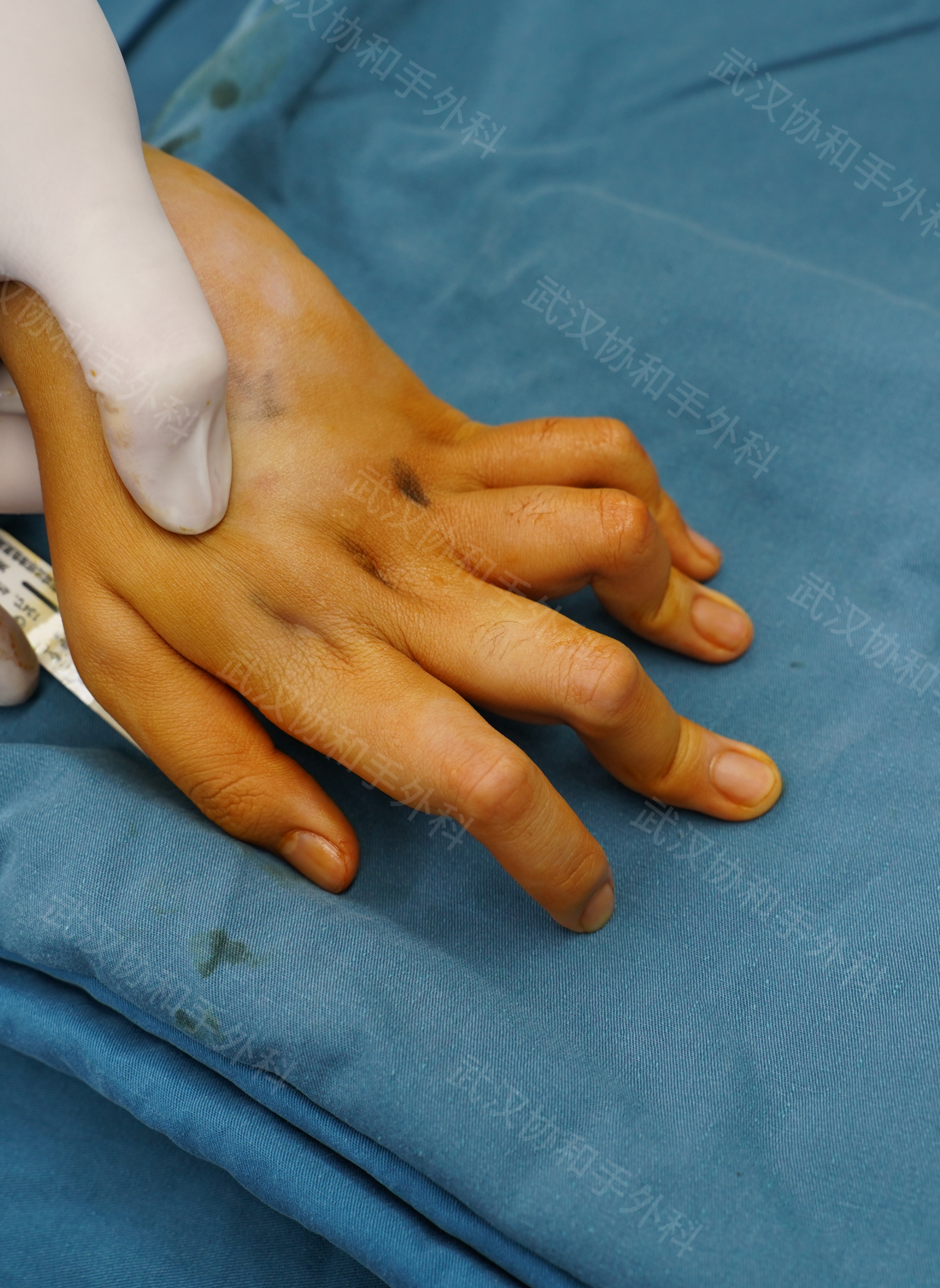 手指扭曲伸不直是种什么样的体验?