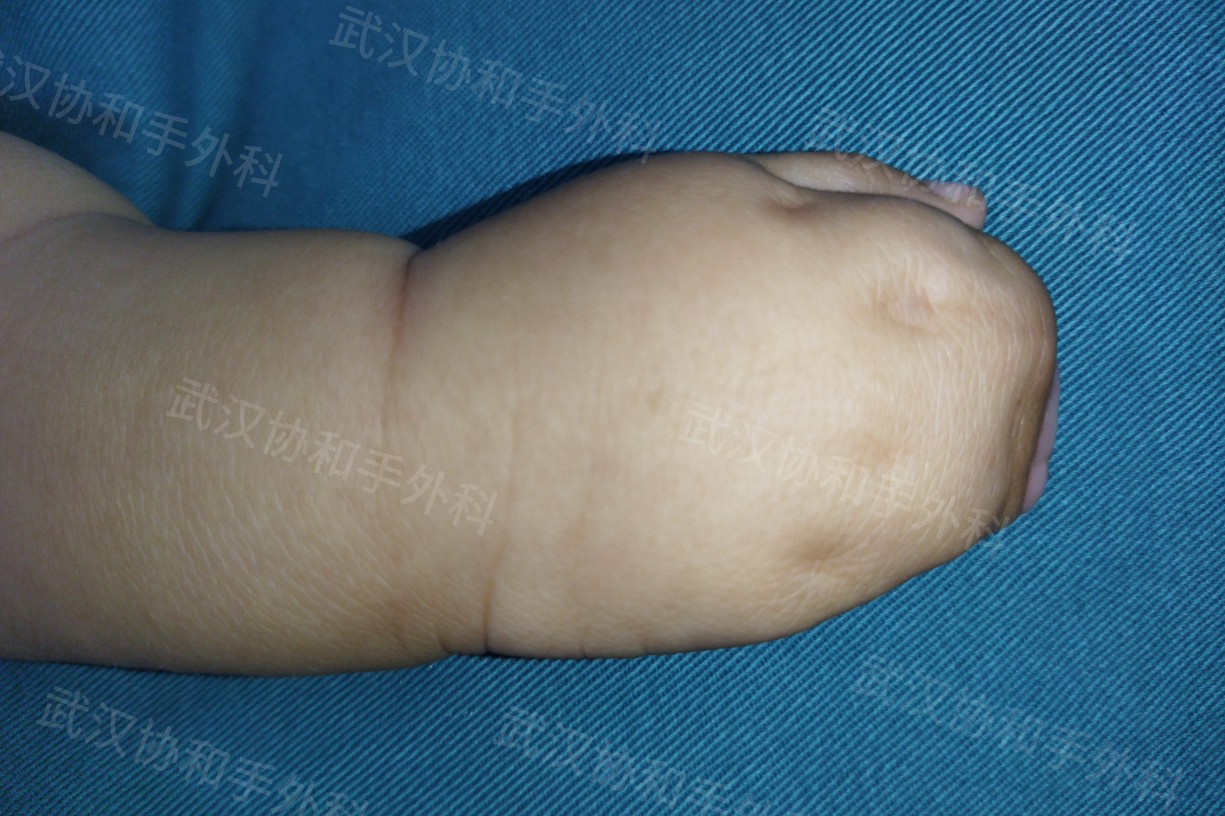 跨越 1500 公里,从青海奔赴武汉只为了将手指分开