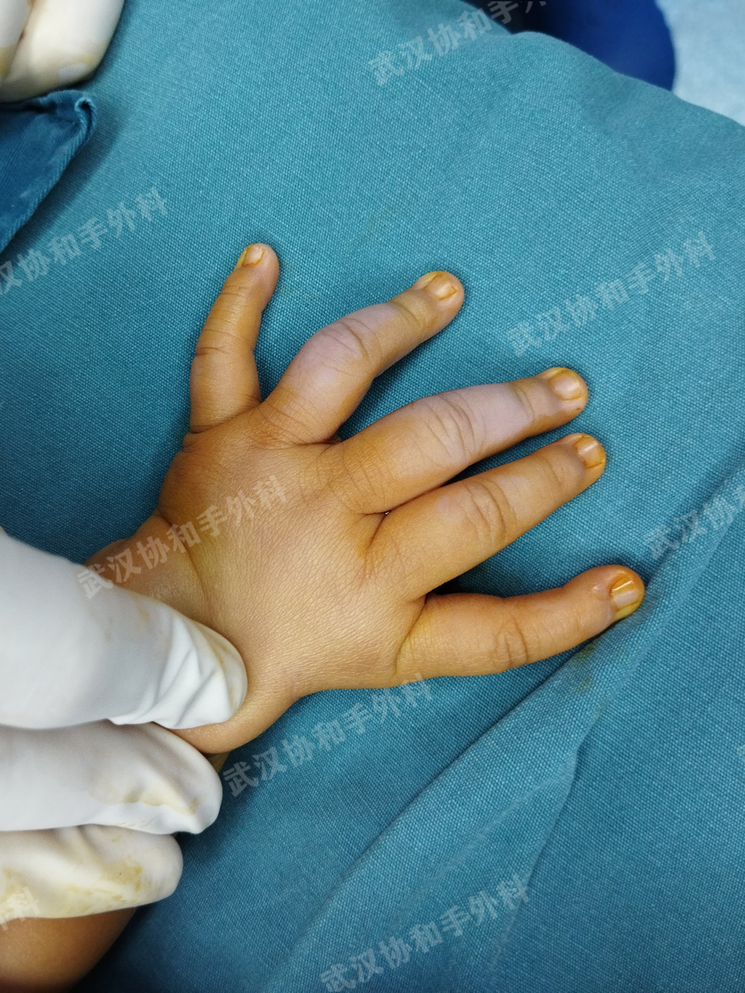 这个孩子情况比较特殊,双手共有11根手指,但双手的大拇指都跟正常人的