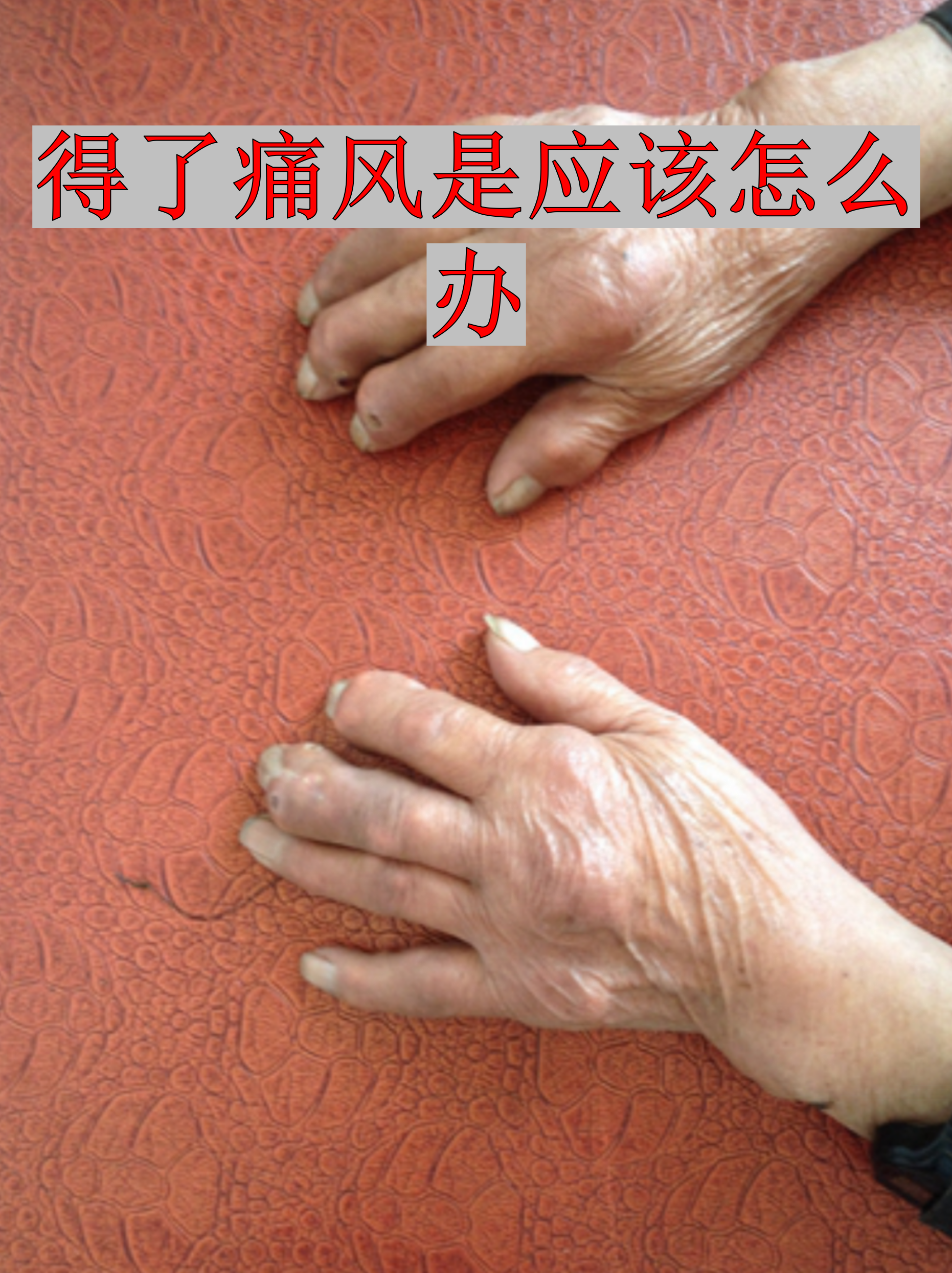 代谢性疾病与高尿酸血症密切相关,但通过科学管理完全可以控制症状