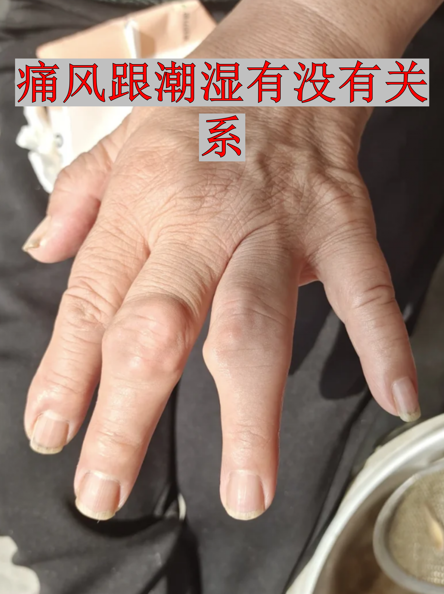 在于湿度变化会影响体内尿酸代谢,加上生活方式改变,可能间接加重症状