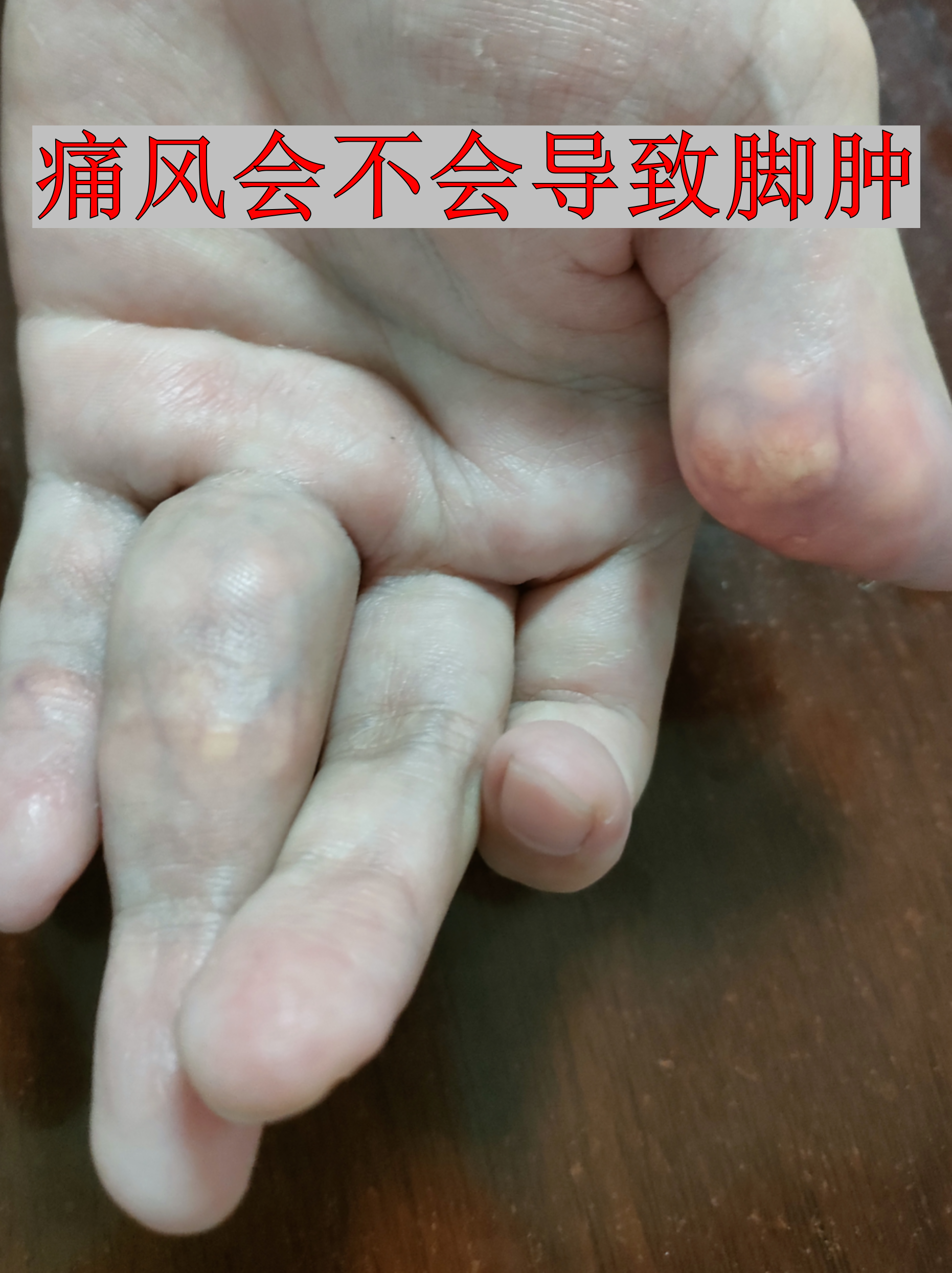 痛风确实会导致脚肿,尤其在急性发作期,大脚趾