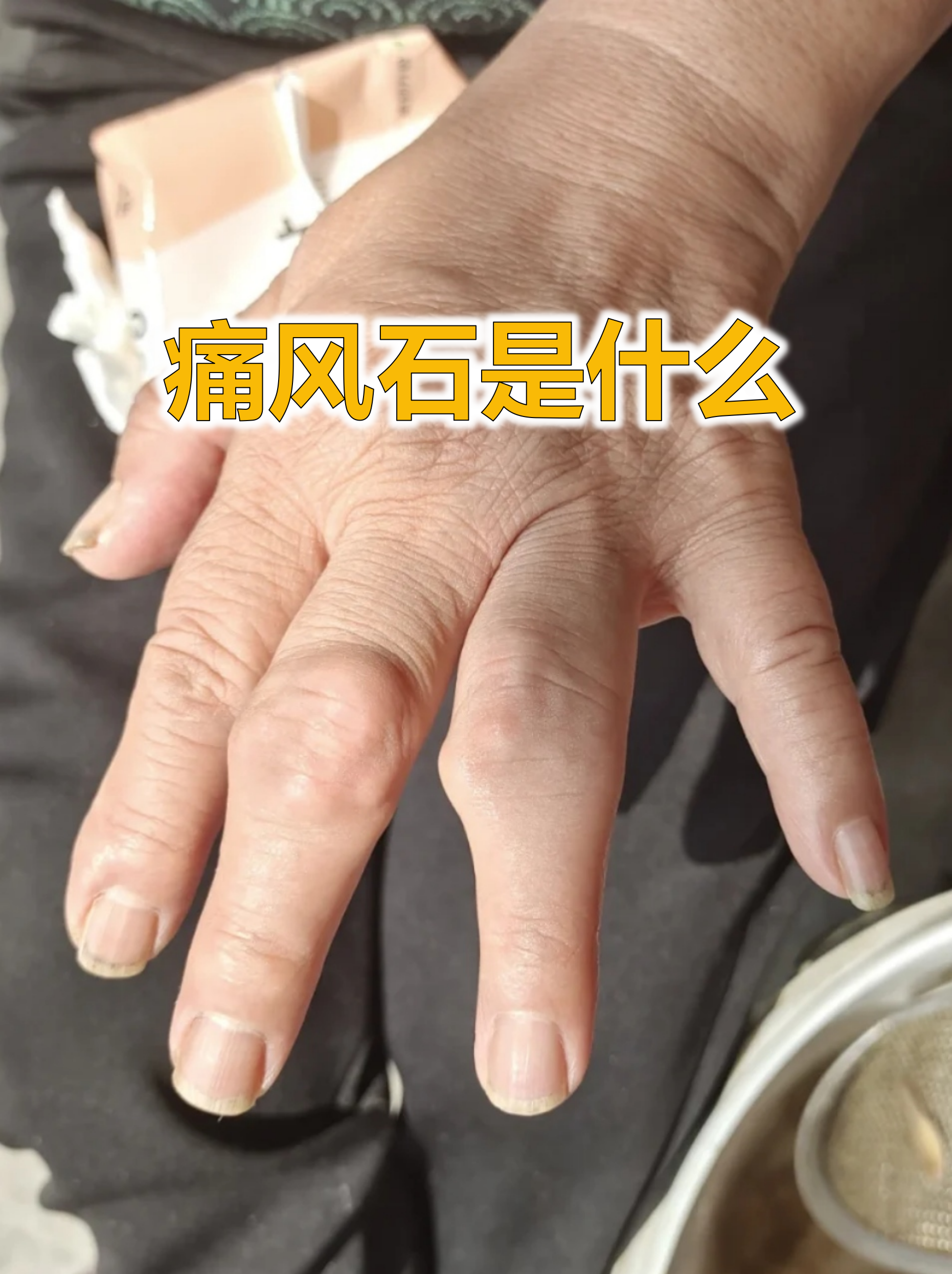 痛风石是痛风患者关节处形成的白色结晶肿块,像藏在