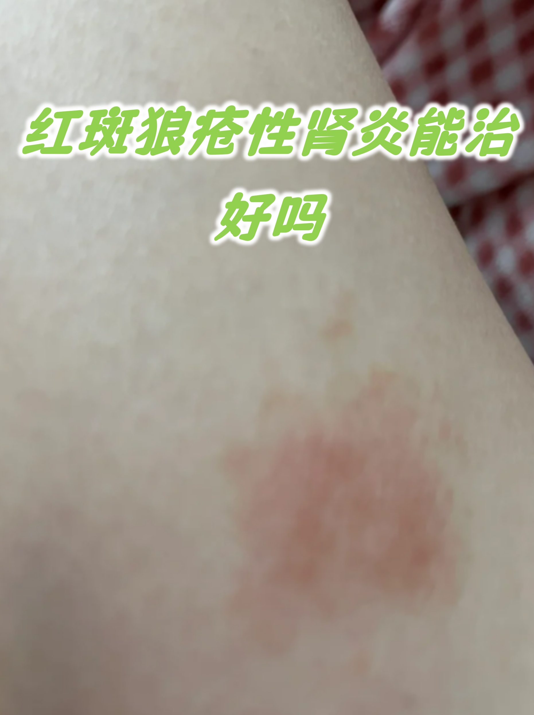 安贞医院代取报告代挂号复杂病情综合分析,治疗方向更明确的简单介绍 安贞医院代取报告代挂号复杂病情综合分析,治疗方向更明确的简单介绍