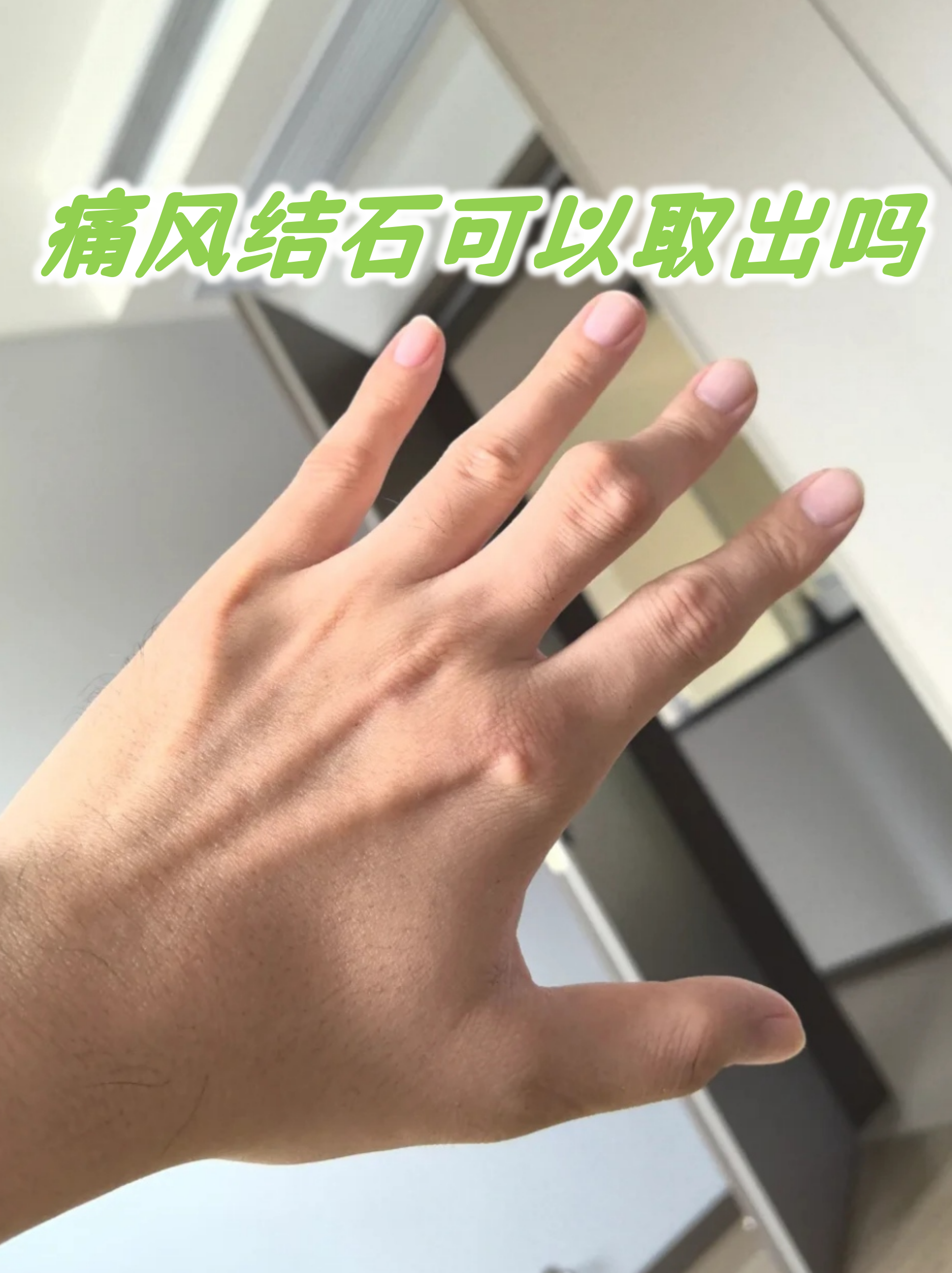 痛风结石是长期尿酸结晶沉积形成的硬块,像藏在