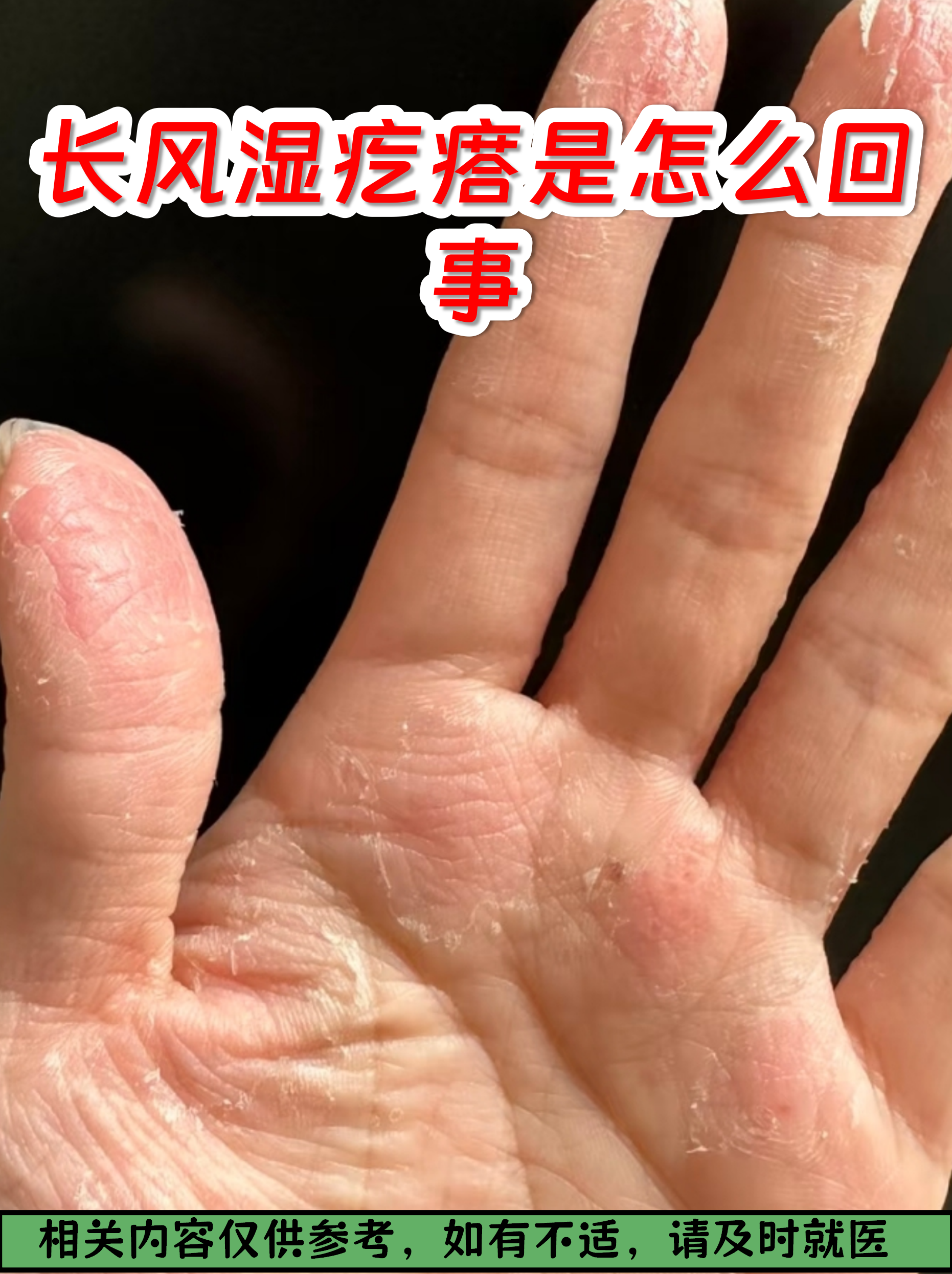 长风湿疙瘩是怎么回事