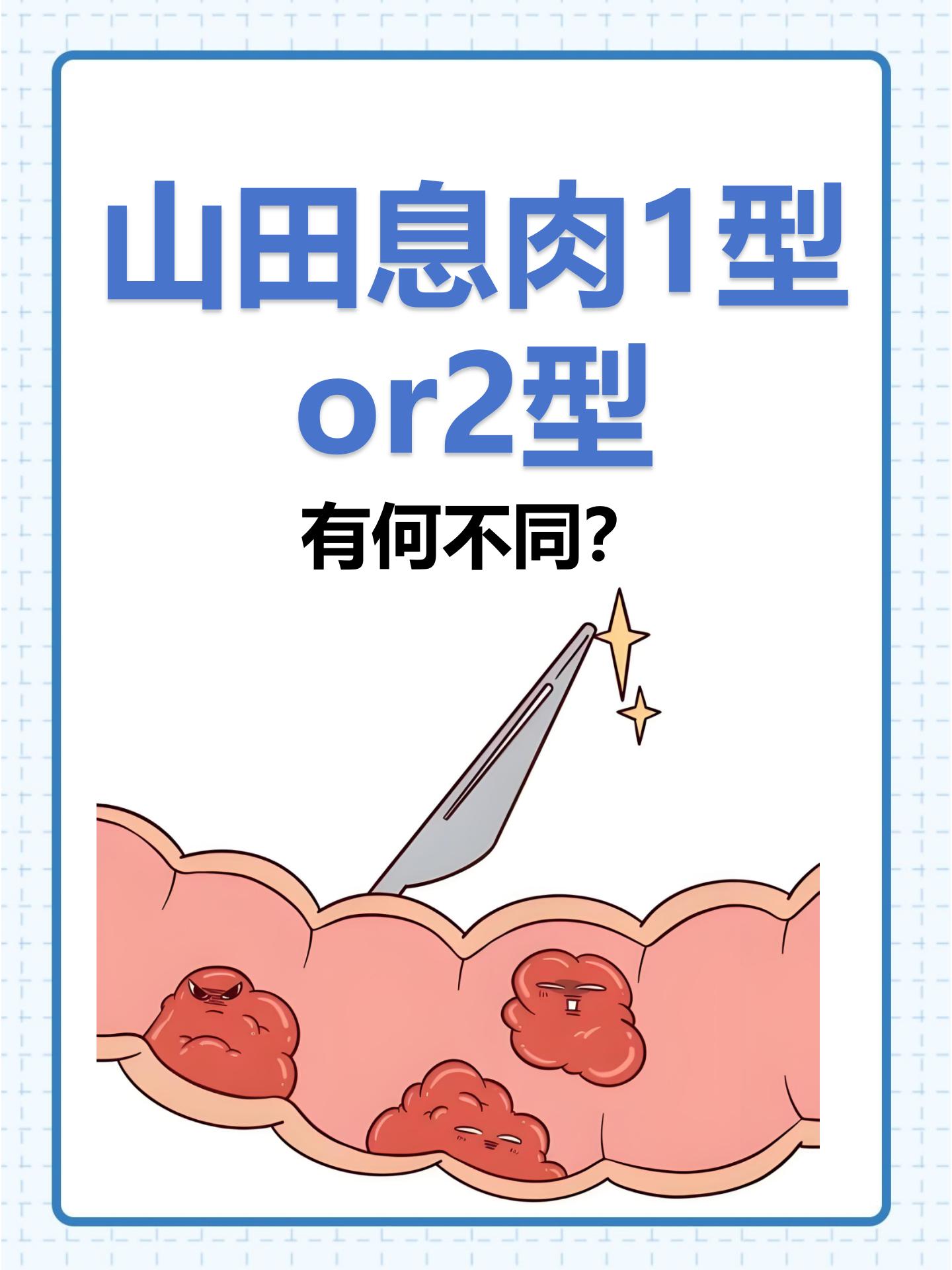 山田2型息肉:相对较大,表面有轻微的不规则或凹陷,呈亚蒂型或广基型