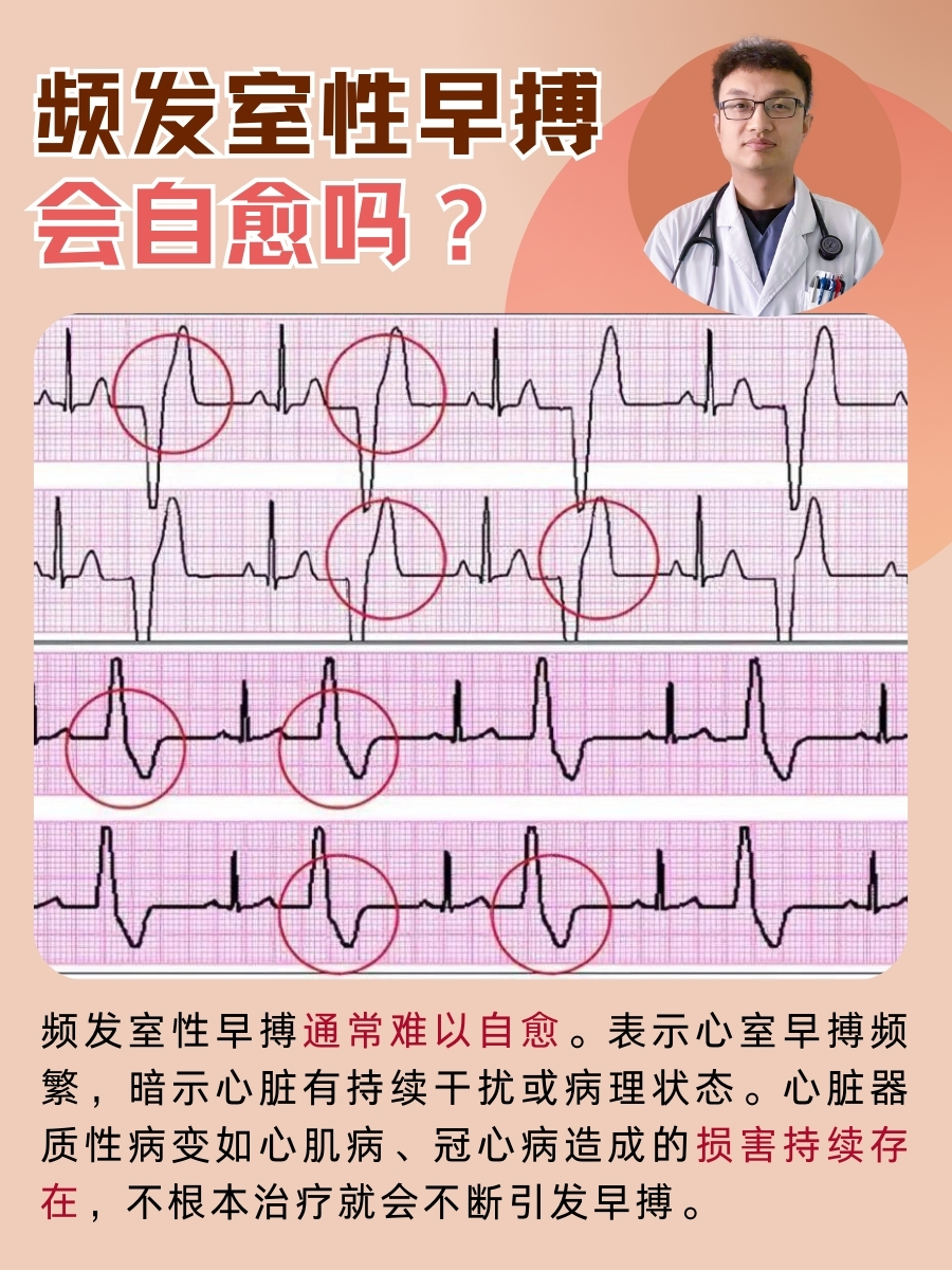 频发性室性早搏图片图片