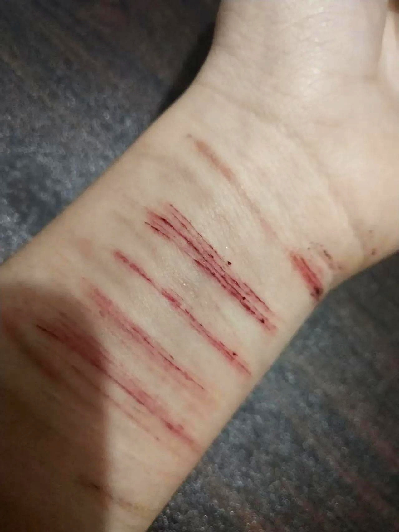 我妈发视频过来说,得了抑郁症的女儿又自残了