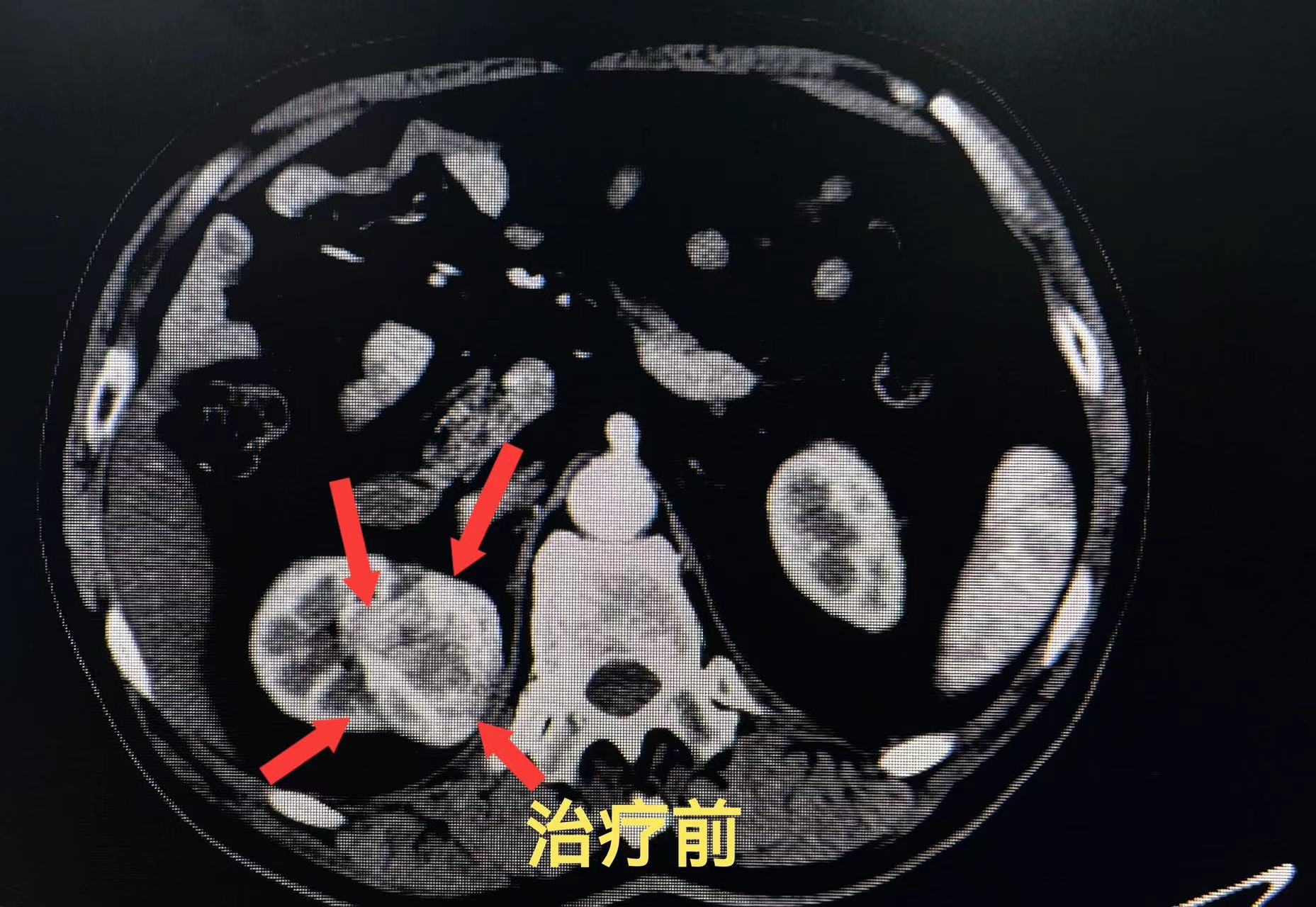 右肾门肿物,肿瘤不大可是位置刁钻,直接手术保肾难度极大,且可能