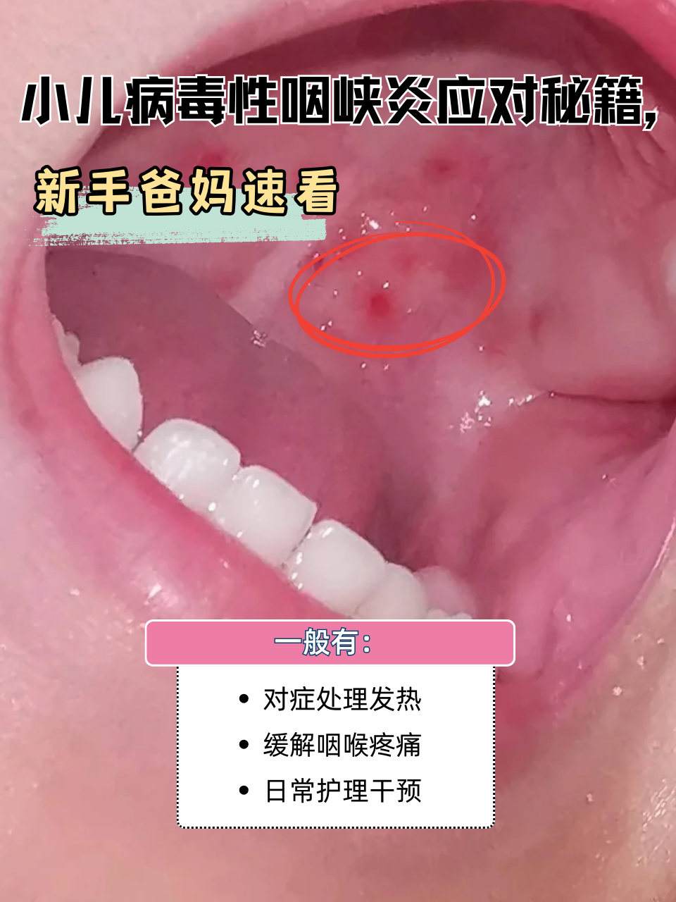 小儿病毒性咽峡炎怎么办 对症处理发热:当孩子体温低于38