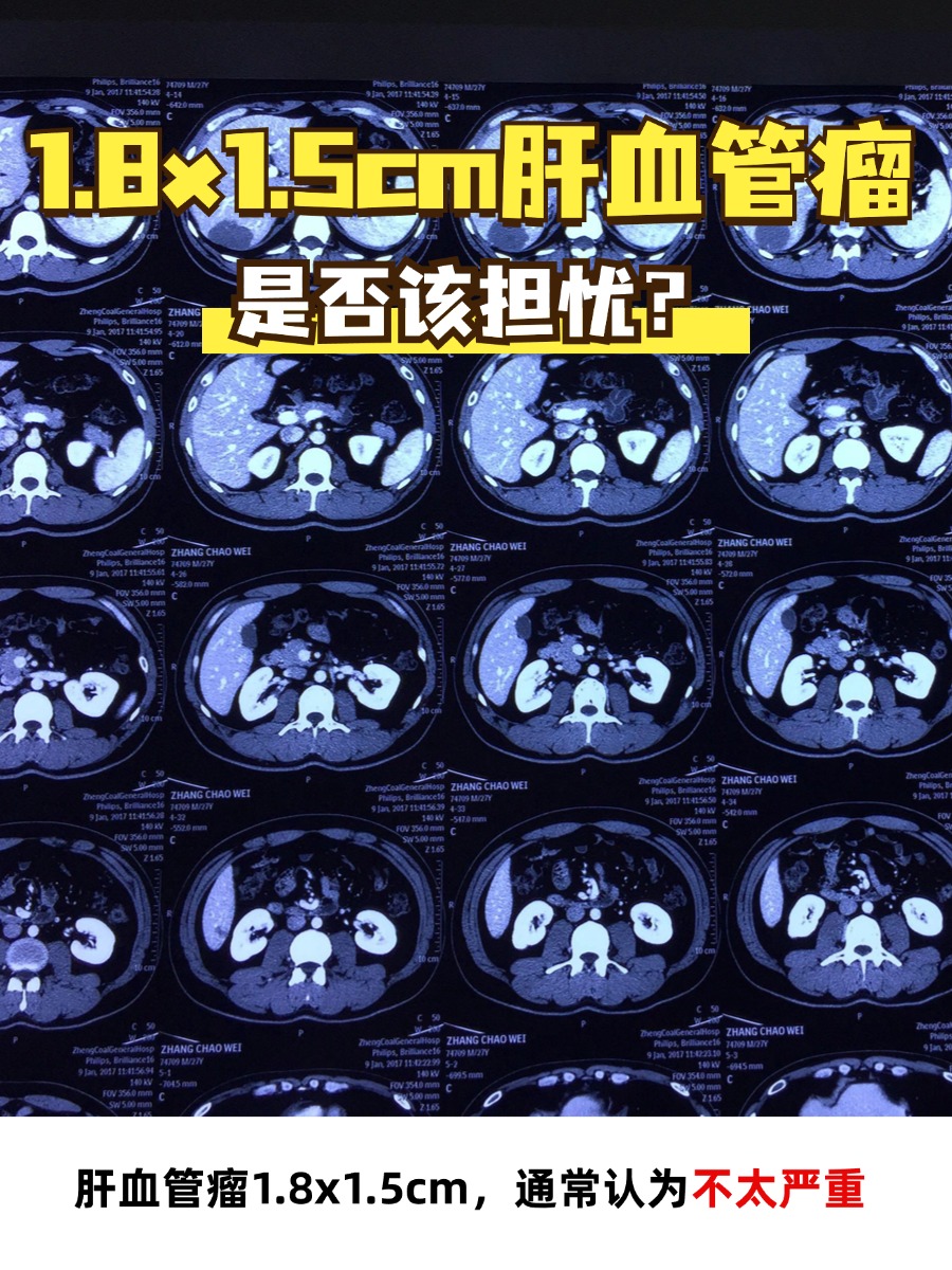 8x1.5cm肝血管瘤,是否该担忧?