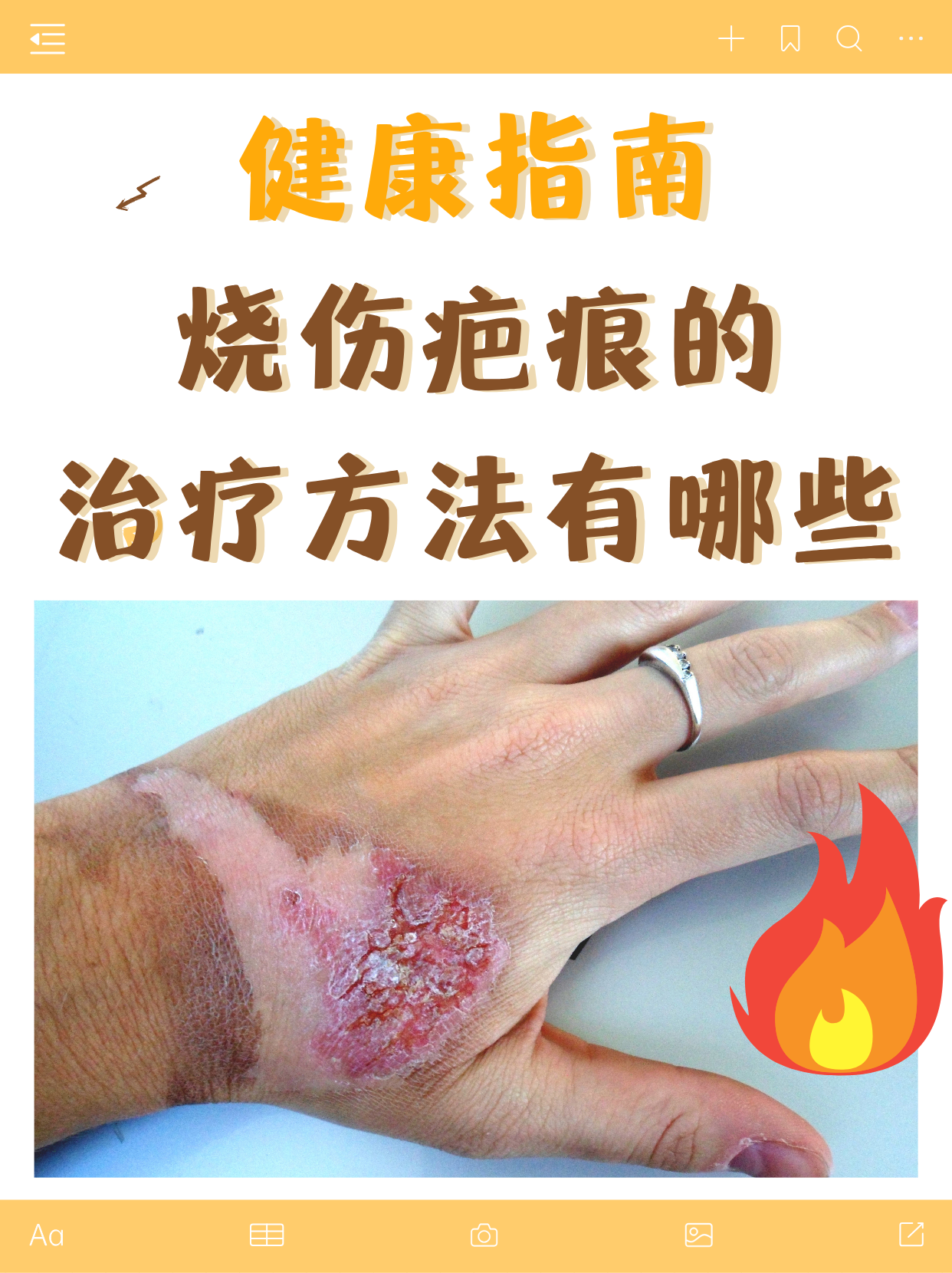烧伤疤痕是烧伤创面愈合后,皮肤组织在修复过程