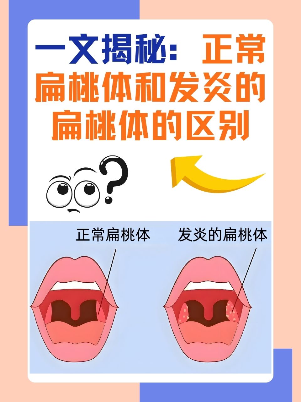 扁桃体为什么会发炎