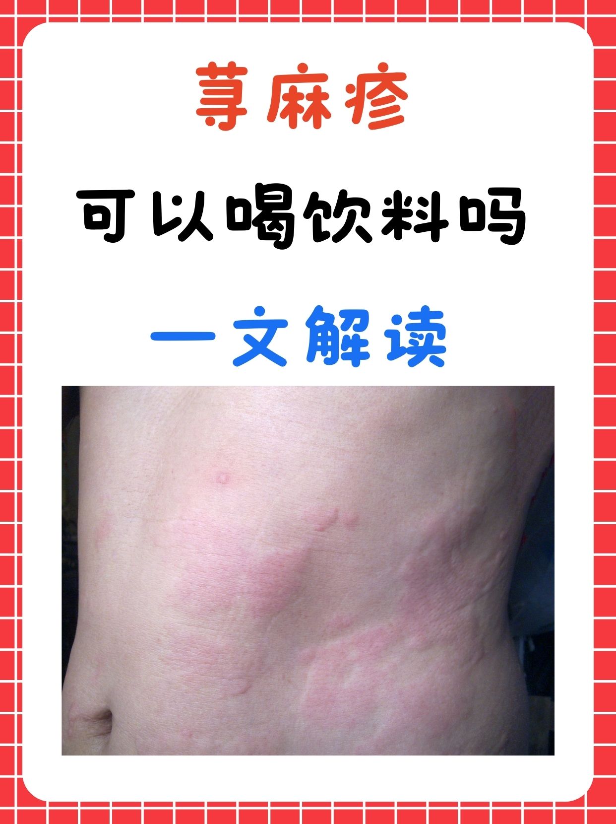 作为一种常见的皮肤过敏反应,其症状包括皮肤上出现红色,肿胀,瘙痒的