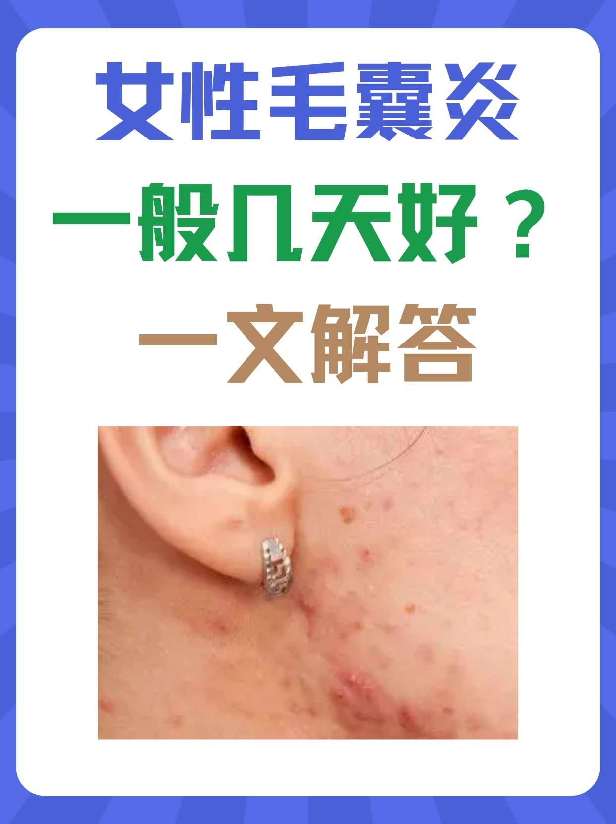 皮囊炎会传染吗?图片