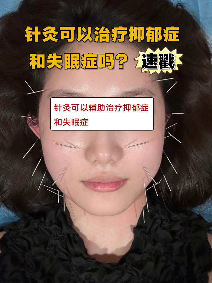 针灸哪里一针就死(针灸是哪里疼打哪里吗?)