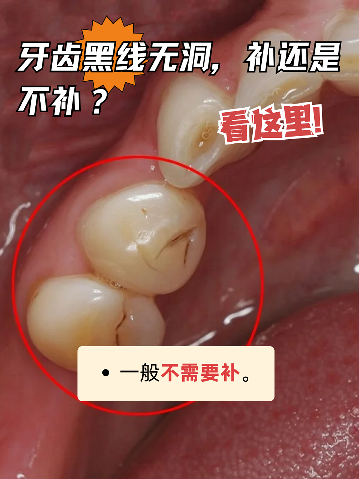 如果在刷牙的时候,发现牙齿中间有一条黑线,但是并没有洞,这种情况