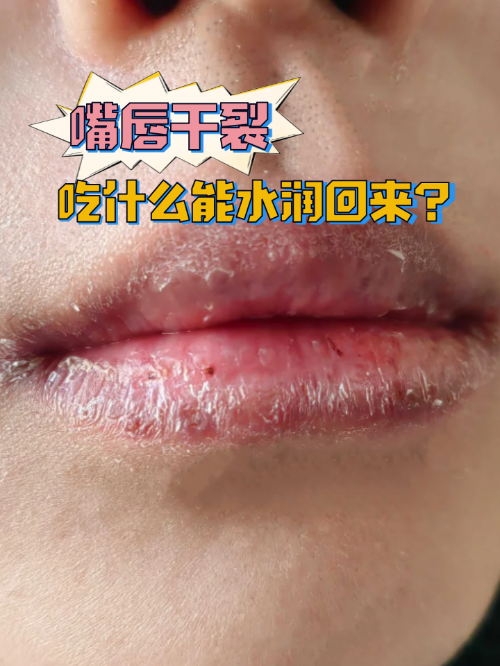 嘴唇为什么老是脱皮指甲总是会弯曲为什么在线 嘴唇为什么老是脱皮指甲总是会弯曲为什么在线