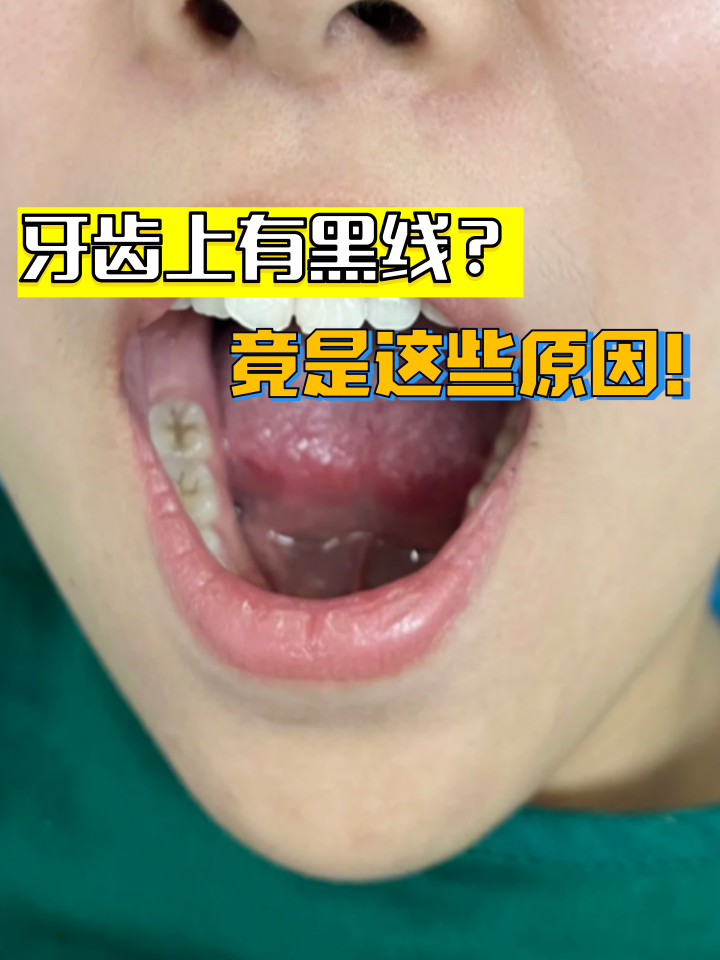 牙隐裂  如何避免色素沉着 饮食调整 做法:尽牙齿黑线铅中毒牙龈铅线