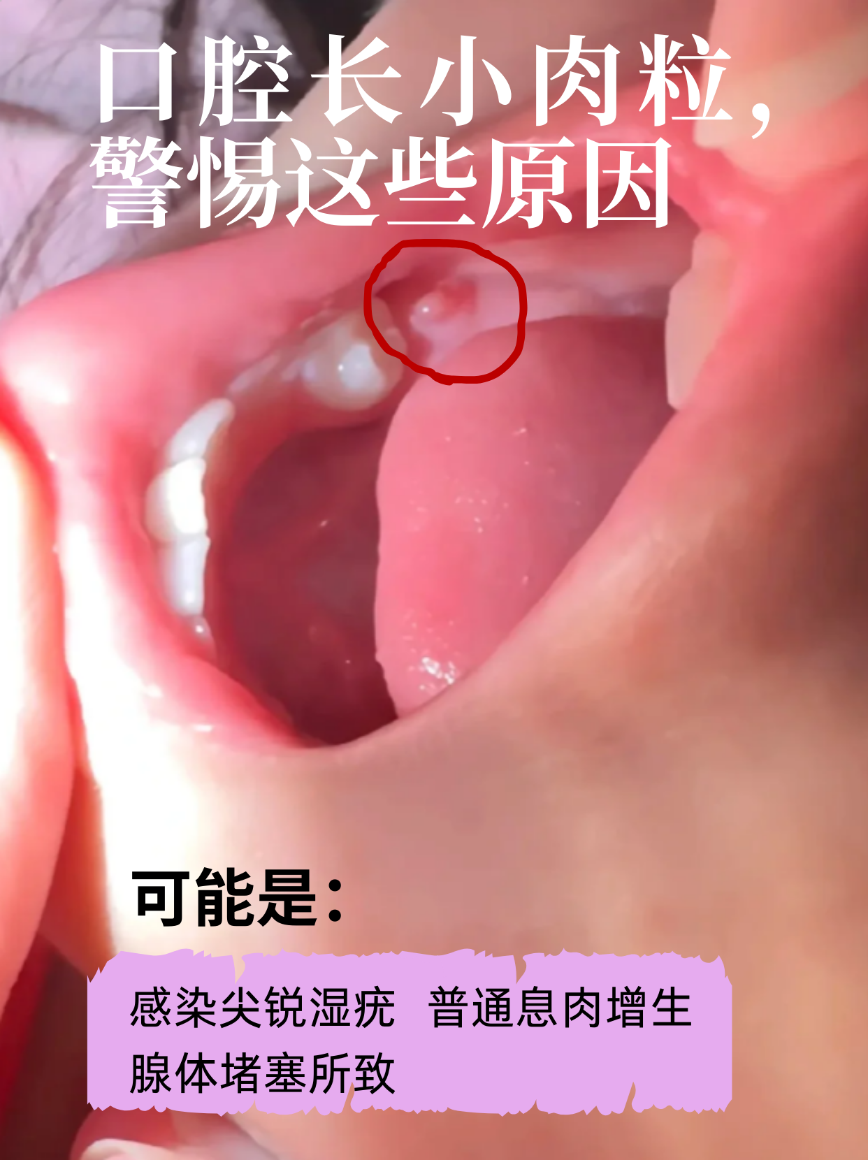口腔初期小疣体图片口腔息肉图片口腔疣体图片口腔乳头状瘤口腔菜花状