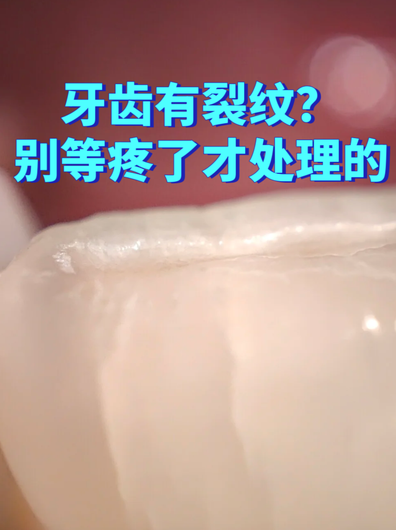 牙齿有裂痕出现是因为什么原因 百度百科为什么在线