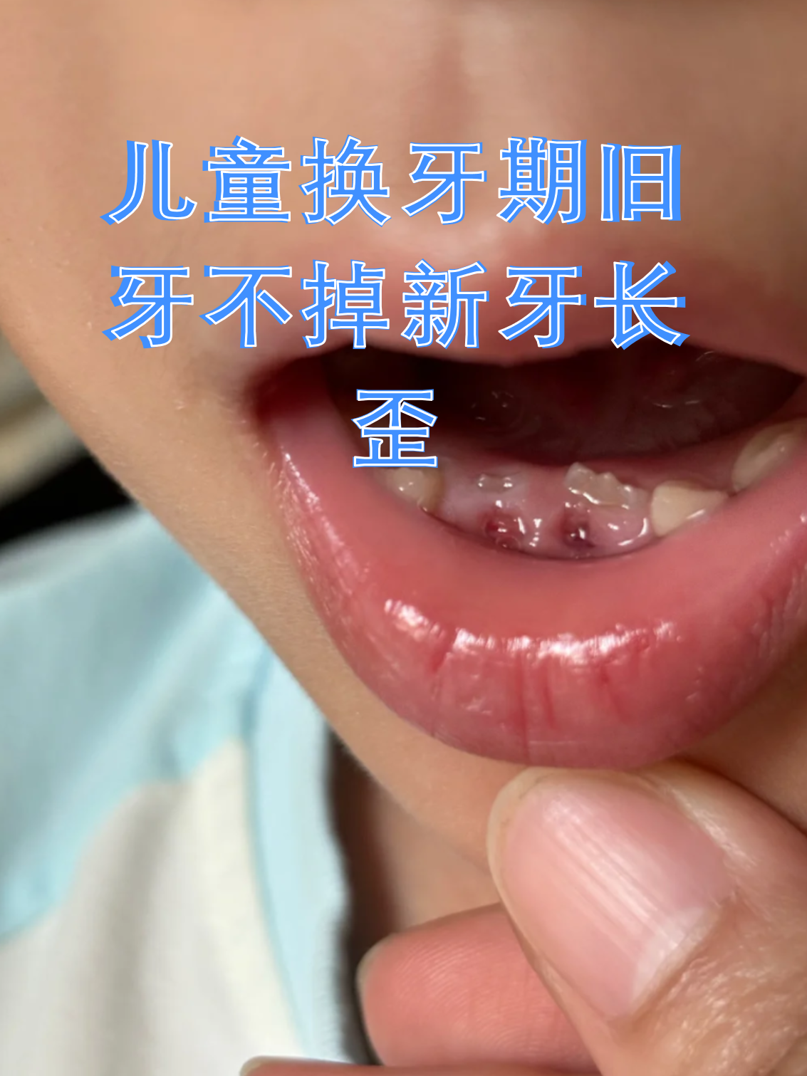 乳牙滞留和新牙错位不仅影响美观,还可能干扰恒牙正常排列,及时干预很