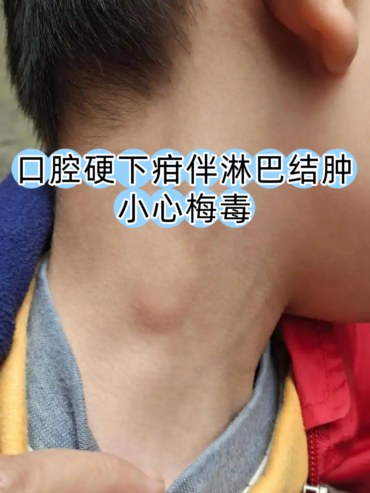 这种由梅毒螺旋体引起的性传播疾病,初期常表现为无痛性溃疡和局部