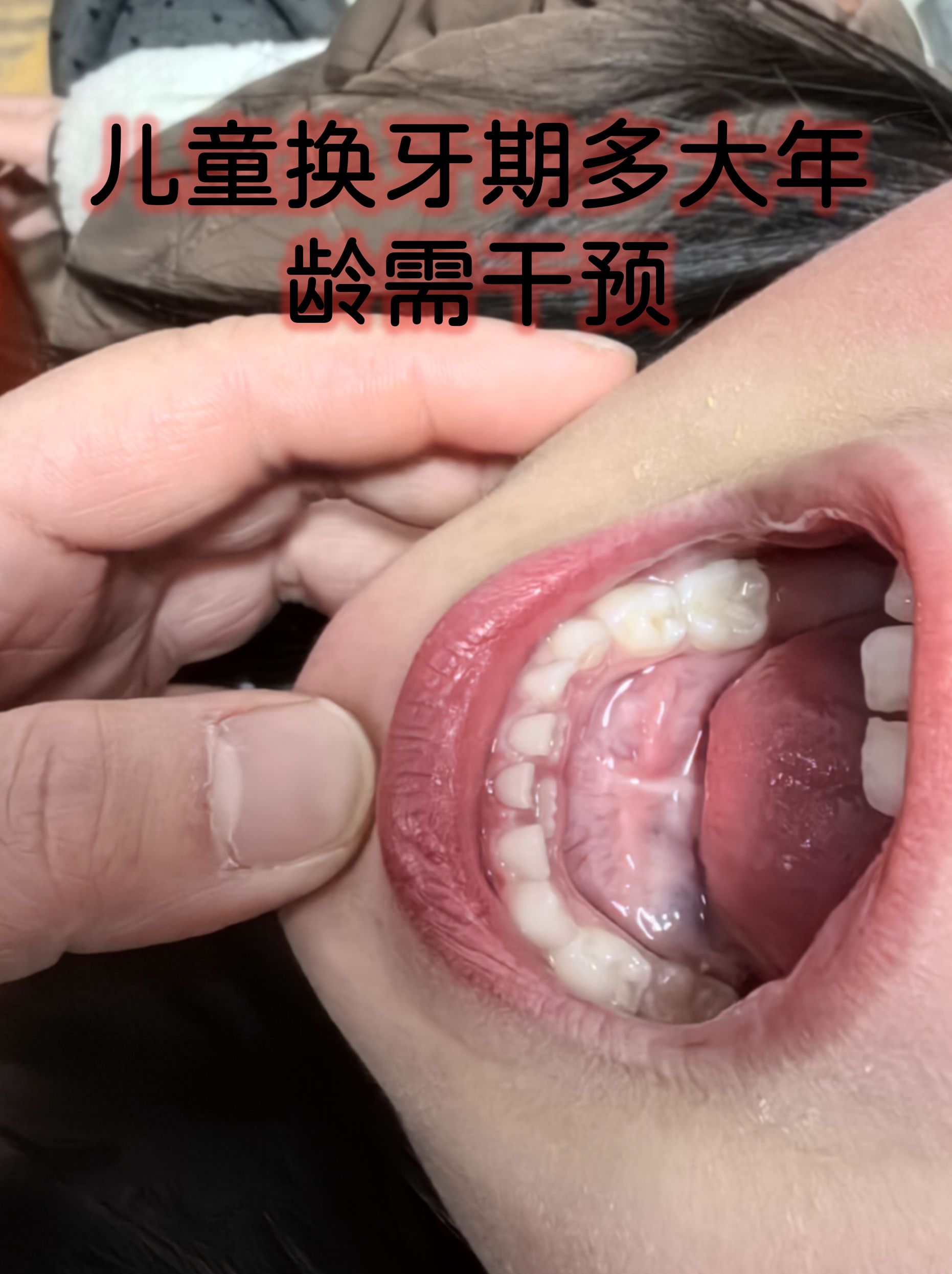 儿童换牙期多大年龄需干预