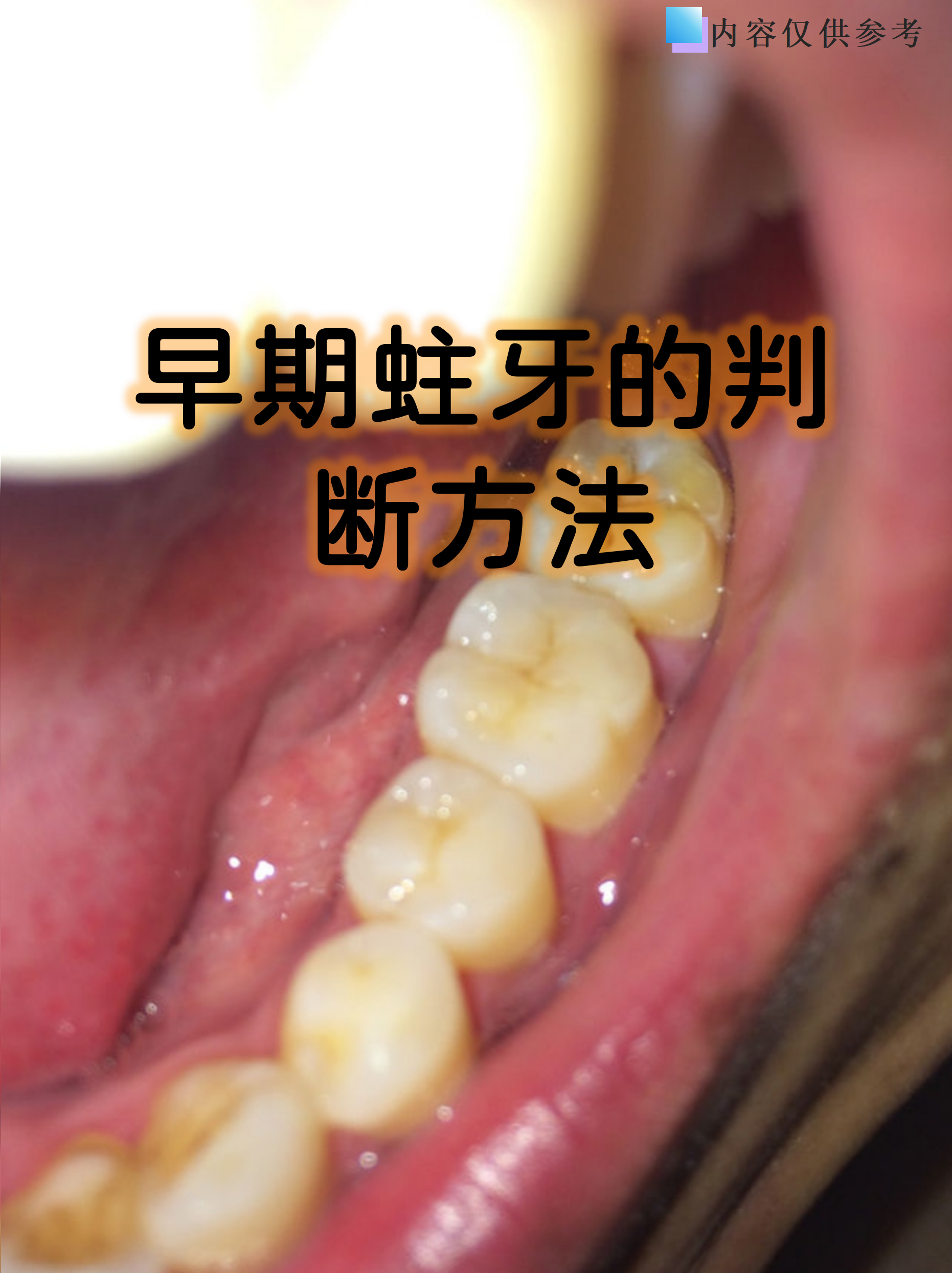 早期蛀牙的判断方法