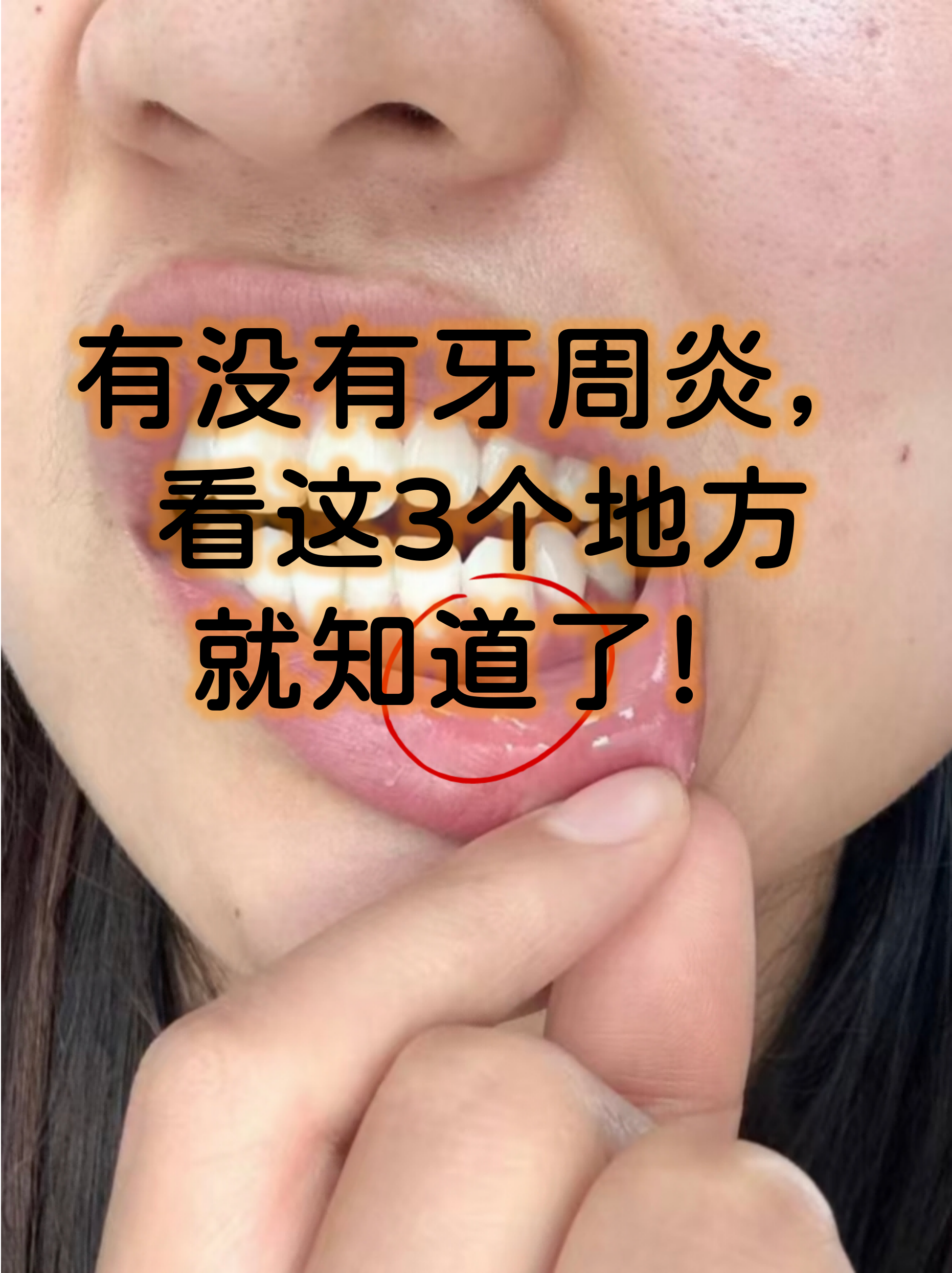 有没有牙周炎,看这3个地方就知道了!