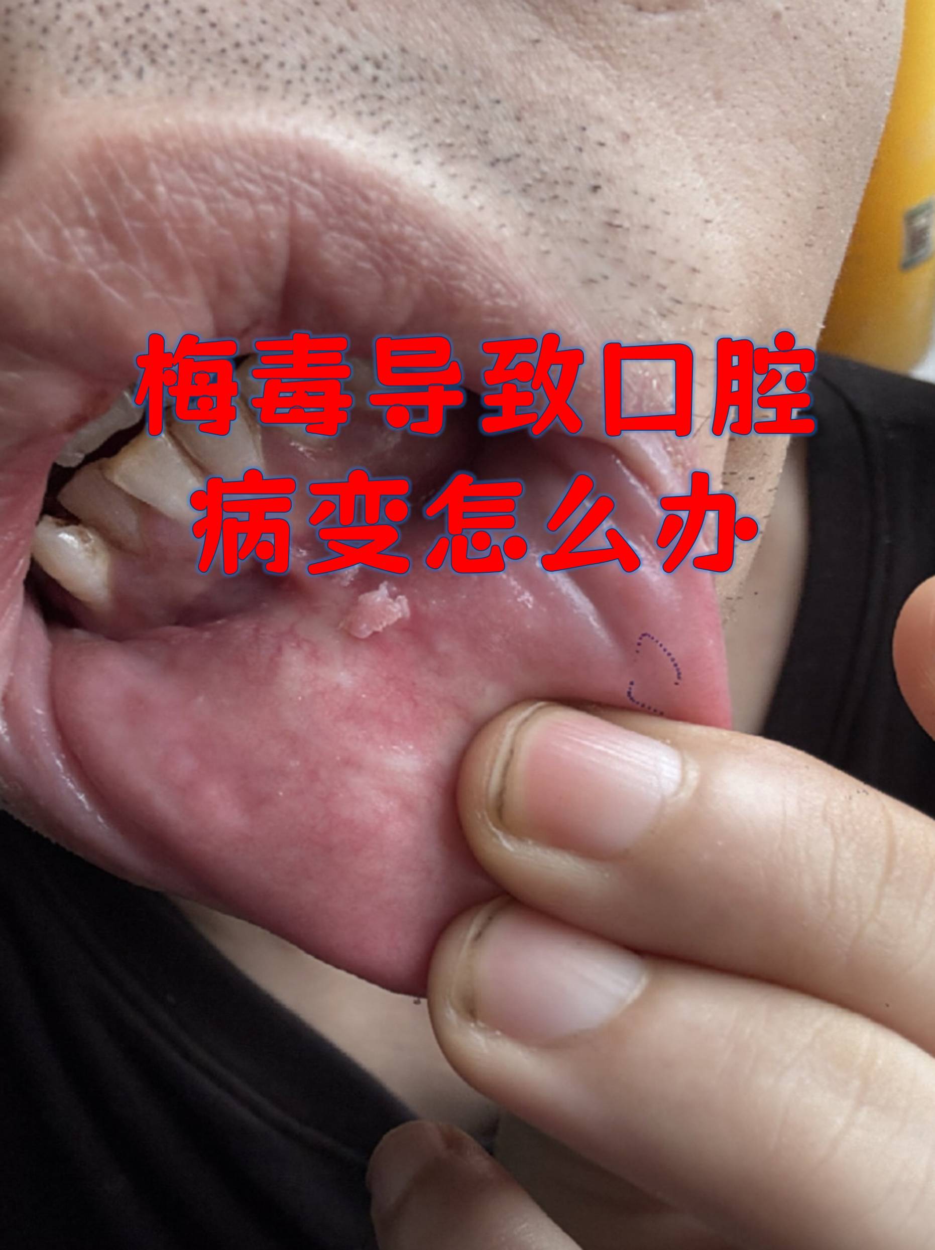 梅毒导致口腔病变怎么办