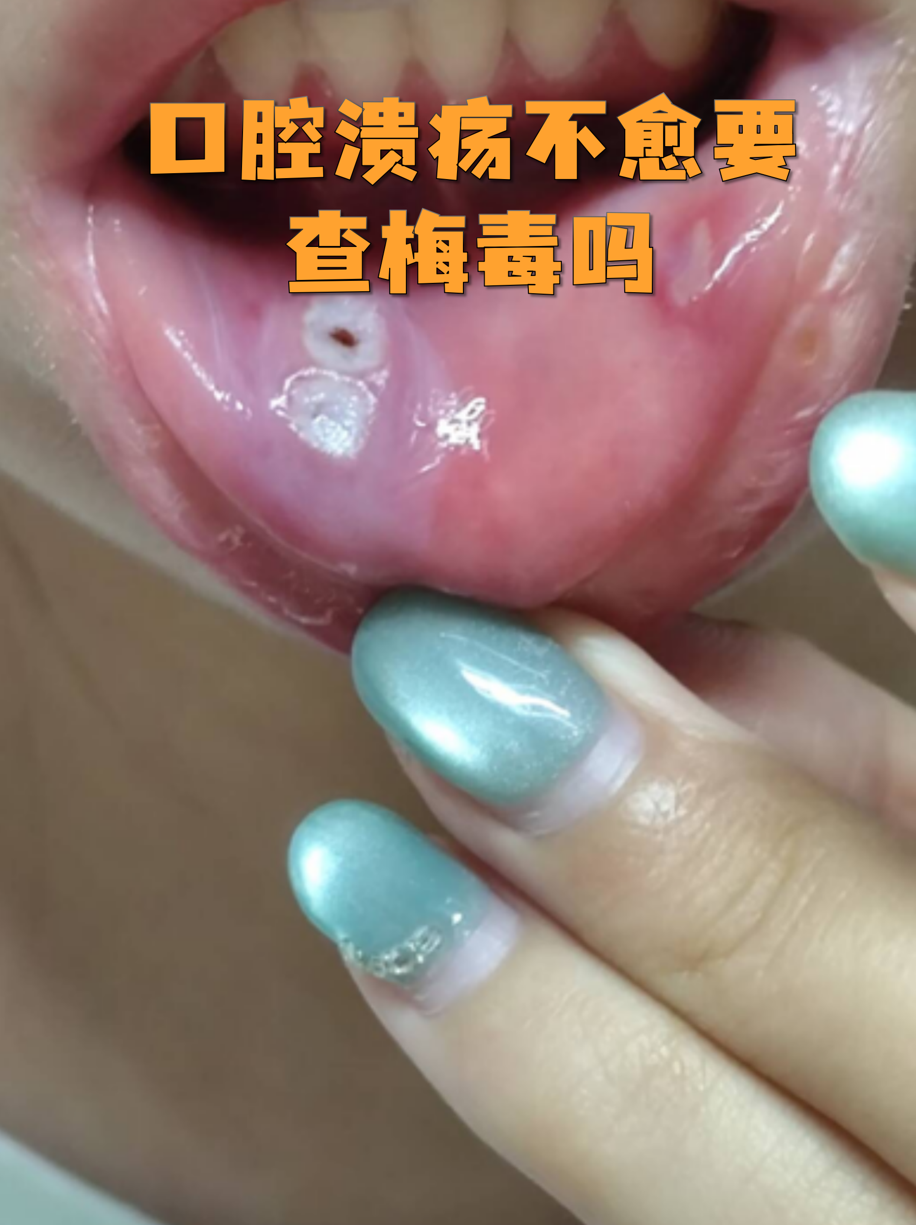  什么病毒会引起持续发烧口腔溃疡发作(什么病毒会引起发烧呕吐)