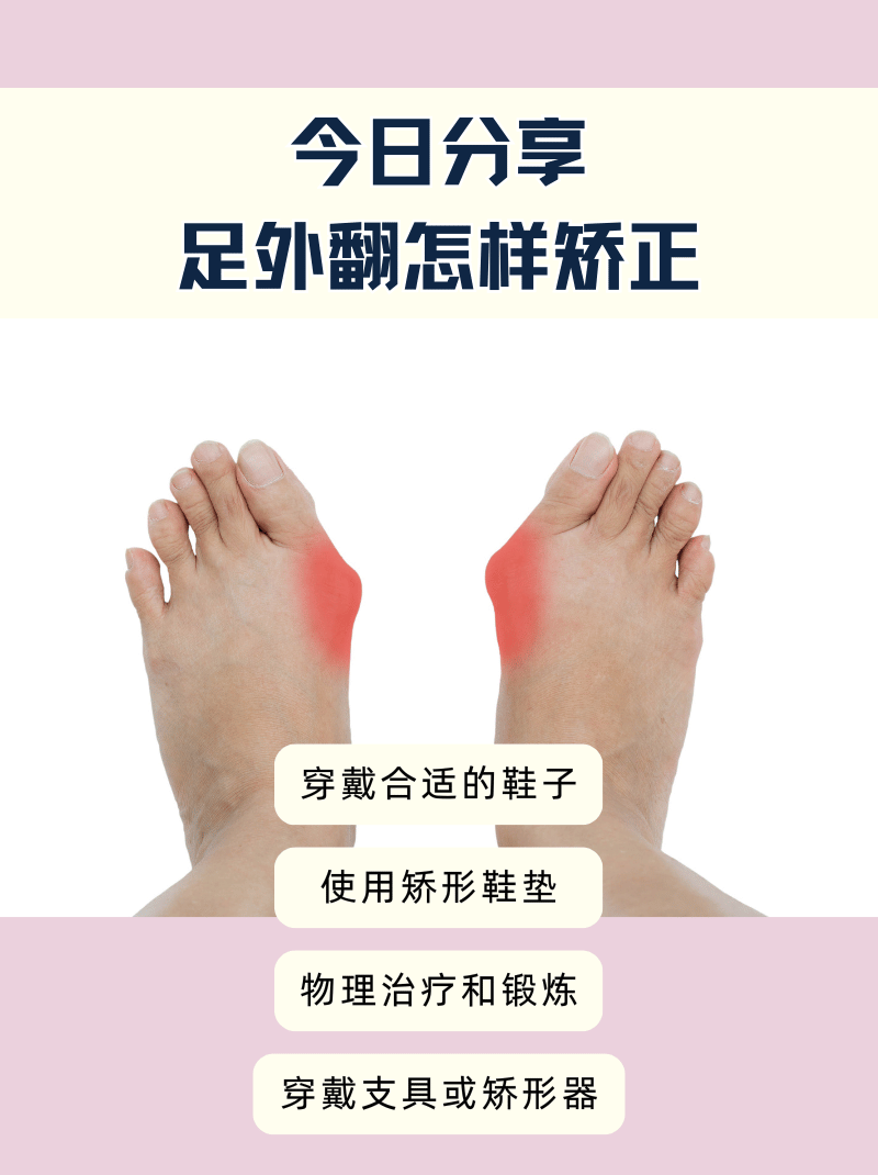 今日分享:足外翻怎样矫正  足外翻是宝宝常见的脚部畸形之一,长期如此