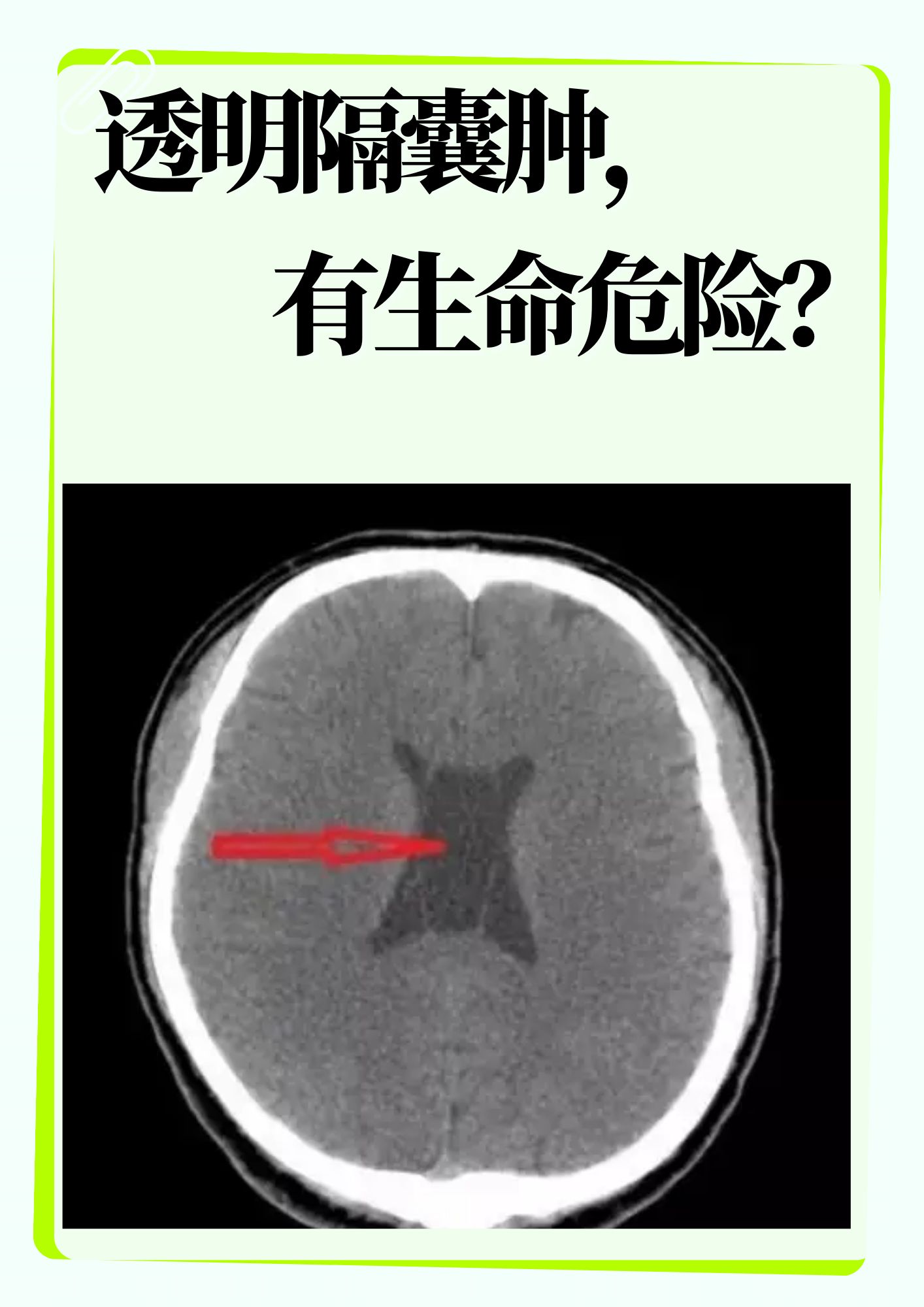 透明隔囊肿,有生命危险?