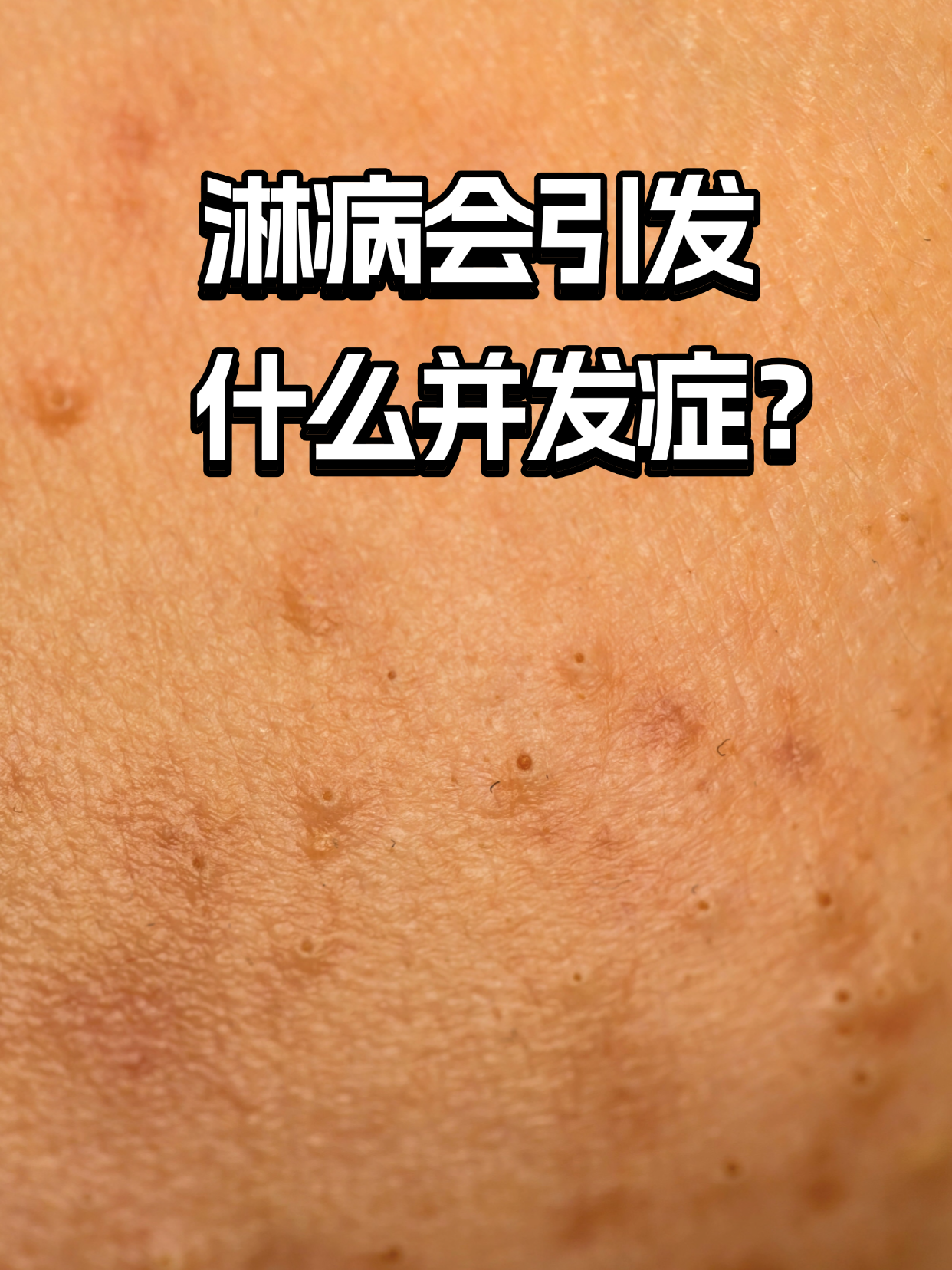 淋病这个看似"低调"的性传播疾病,若不及时干预,可能悄悄引发全身多