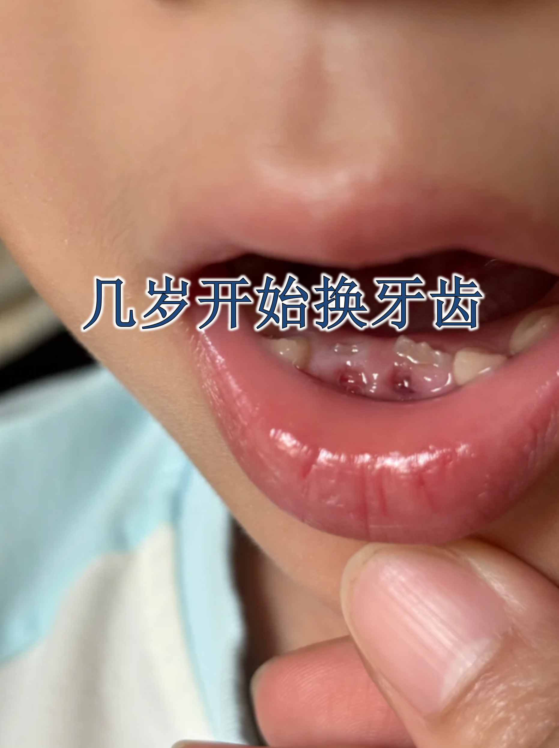 人的一生会经历两次长牙过程,乳牙通常在6个月左右萌出,而换牙则是