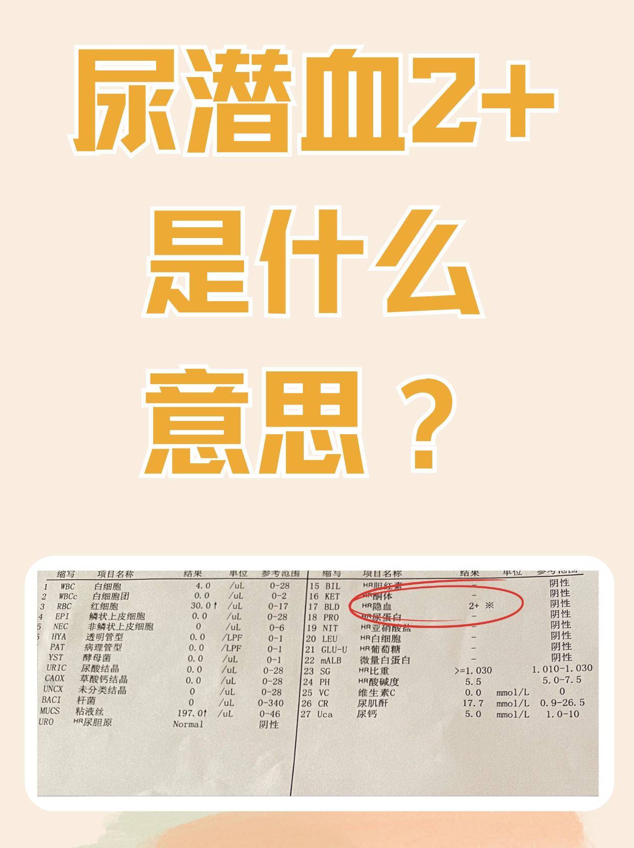 尿潜血2十是怎么回事图片