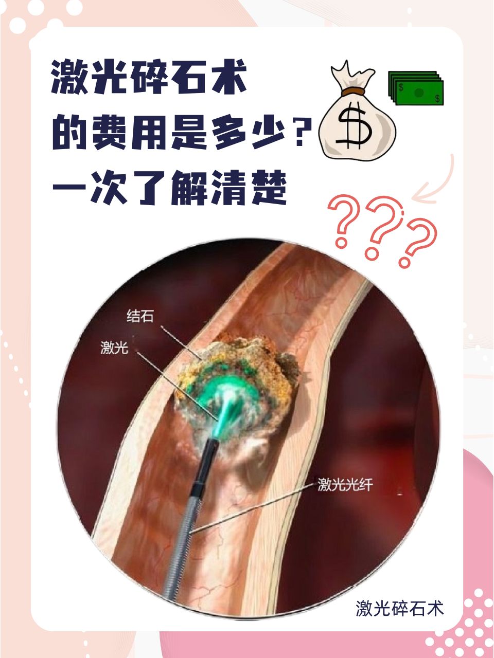 激光碎石术的费用是多少?