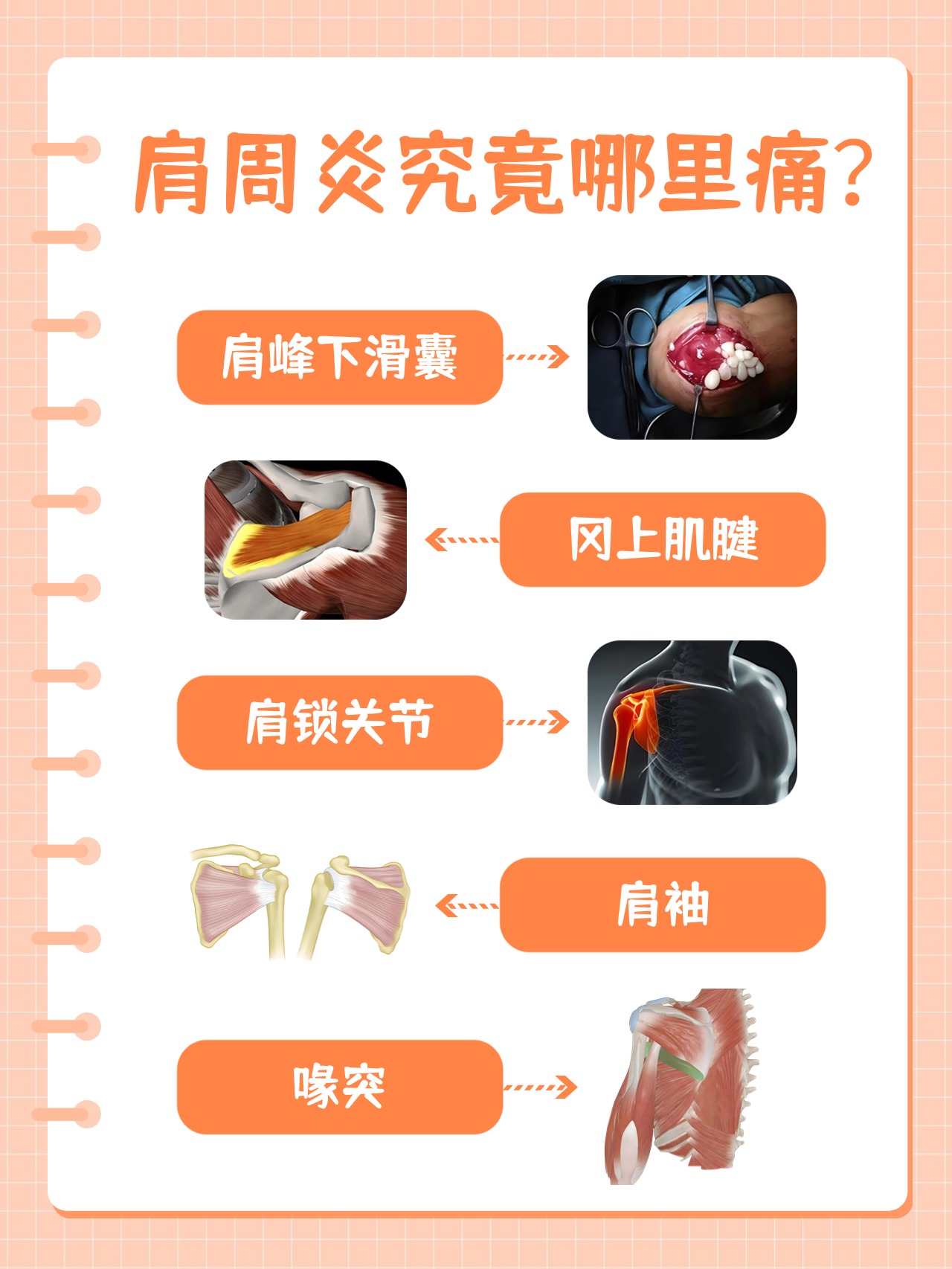 肩袖炎疼痛位置的图片图片