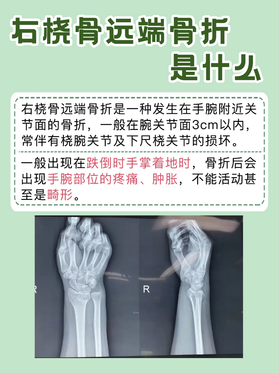右桡骨远端骨折是什么?