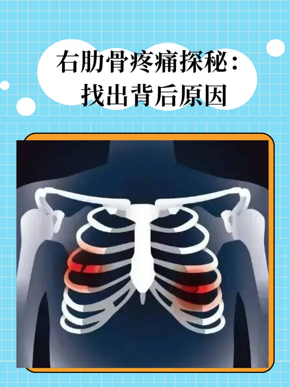 找出背后原因 67右边肋骨疼,可能由多种原因引起,如肋间神经痛,肋骨